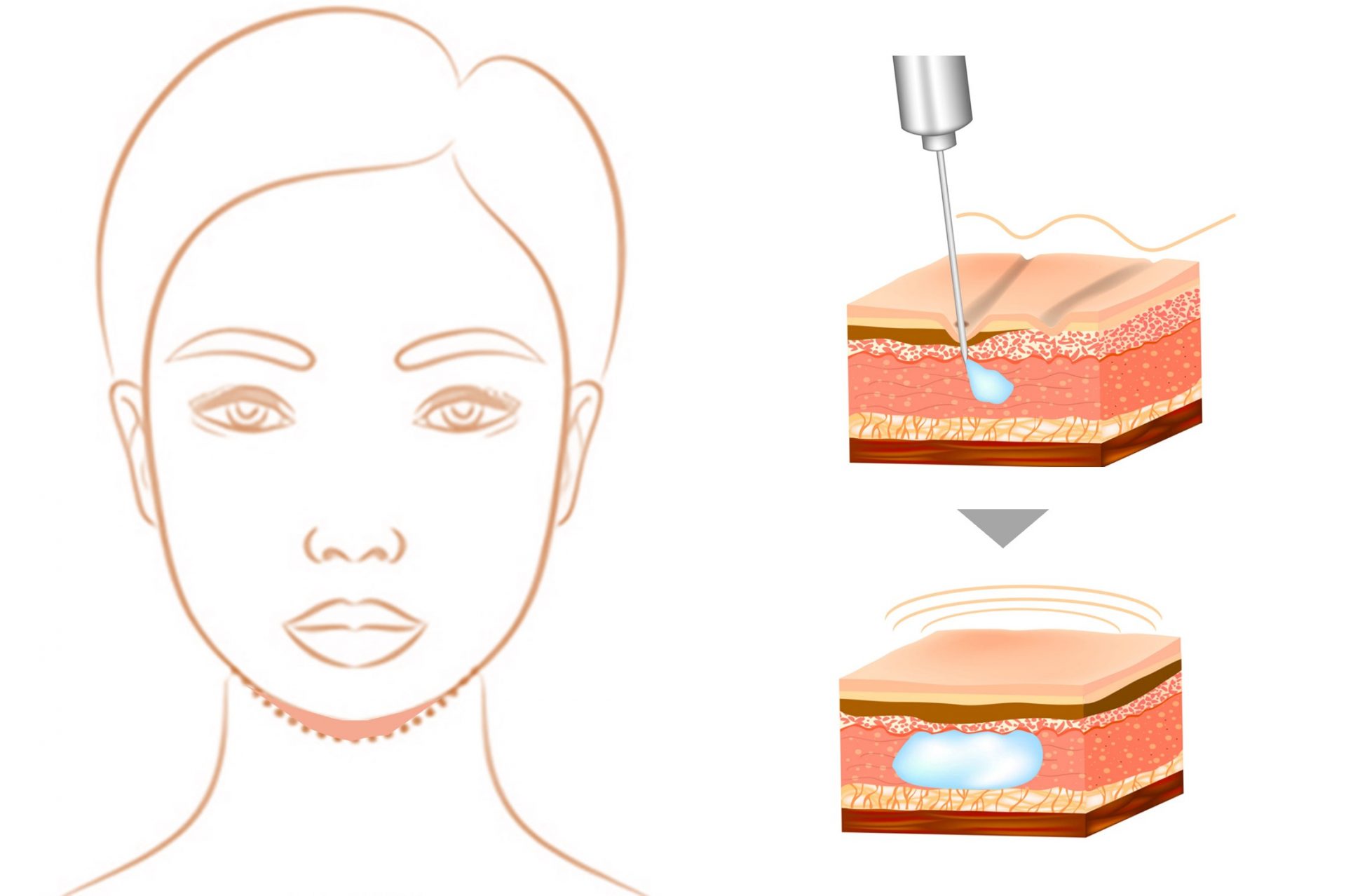 filler v-line treatment singapore