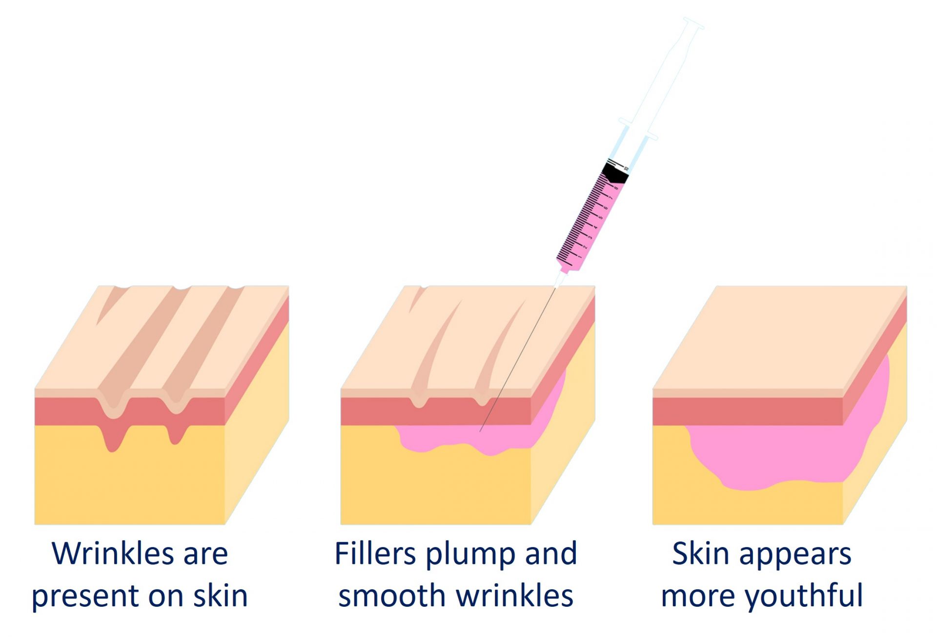 filler injection process