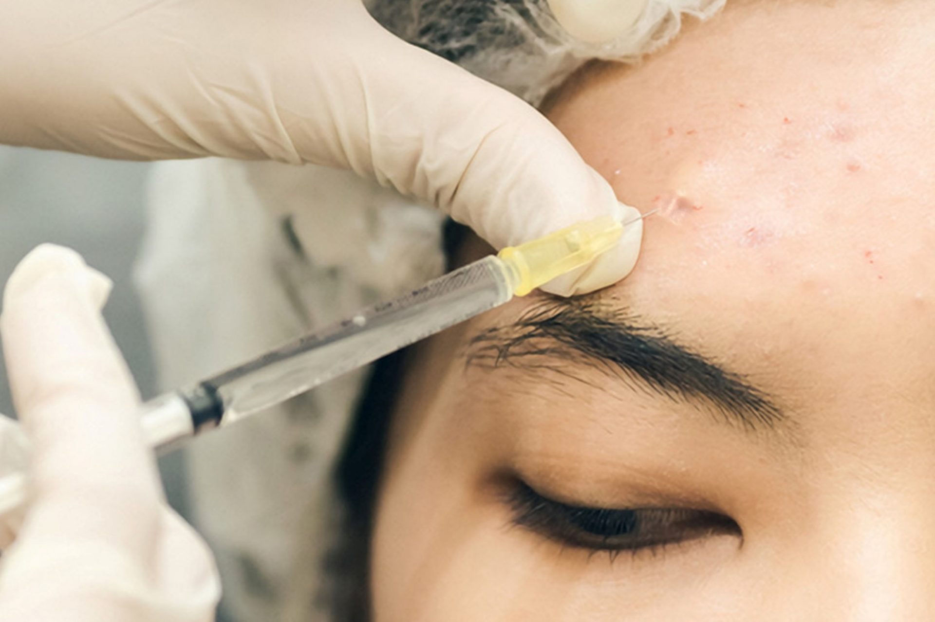 fillers for acne scars