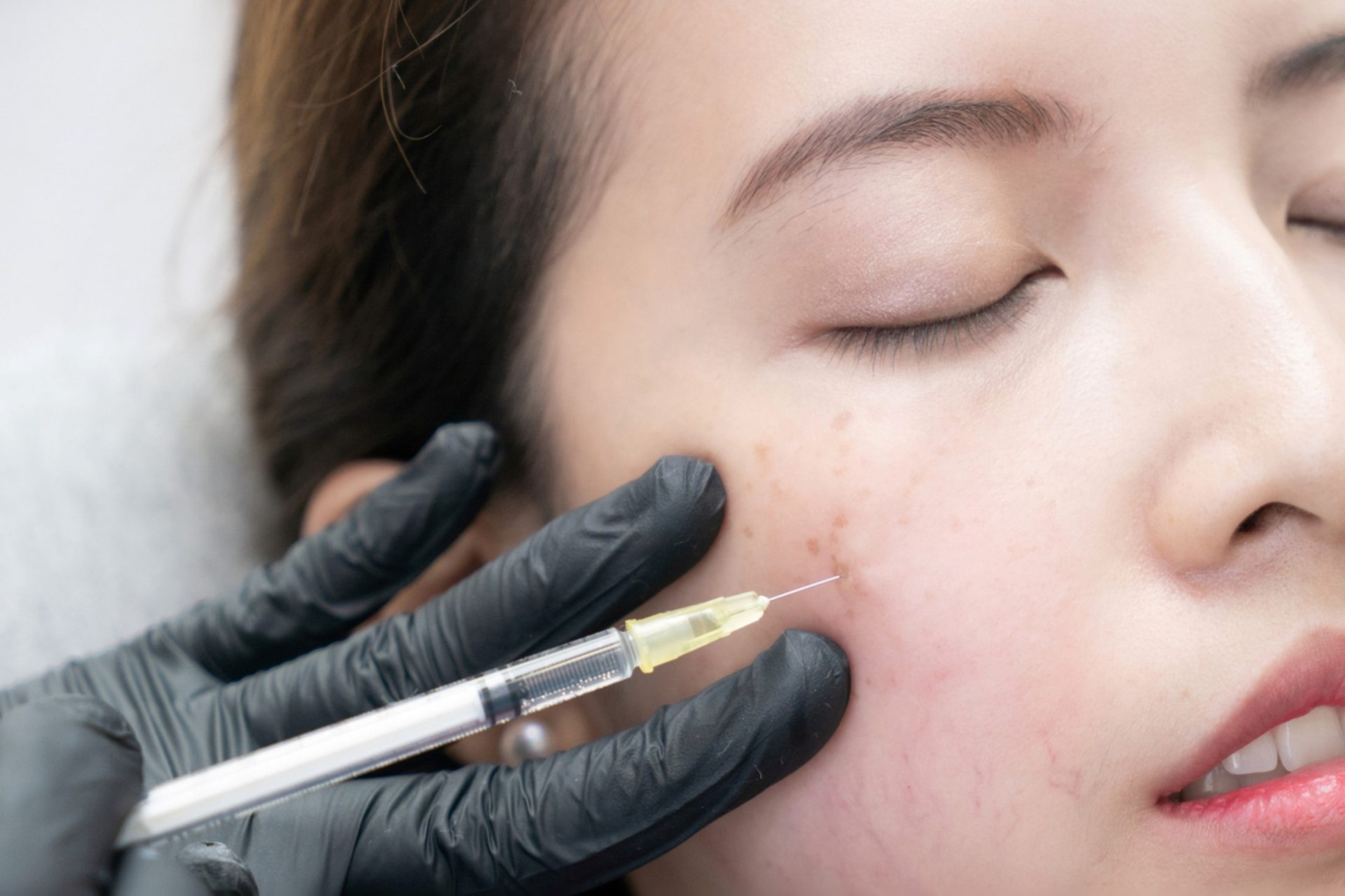 fillers for plumping acne scar