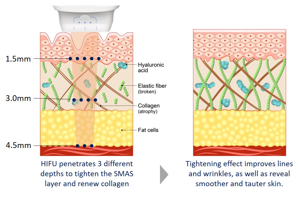 hifu skin rejuvenation process