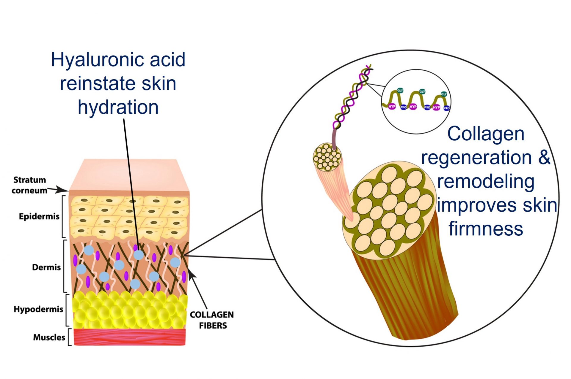 collagen remodeling with filler injection