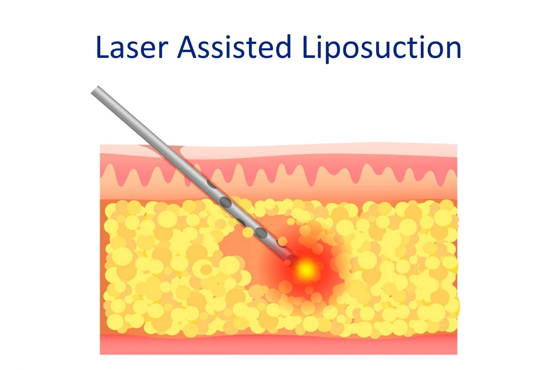 laser assisted liposuction