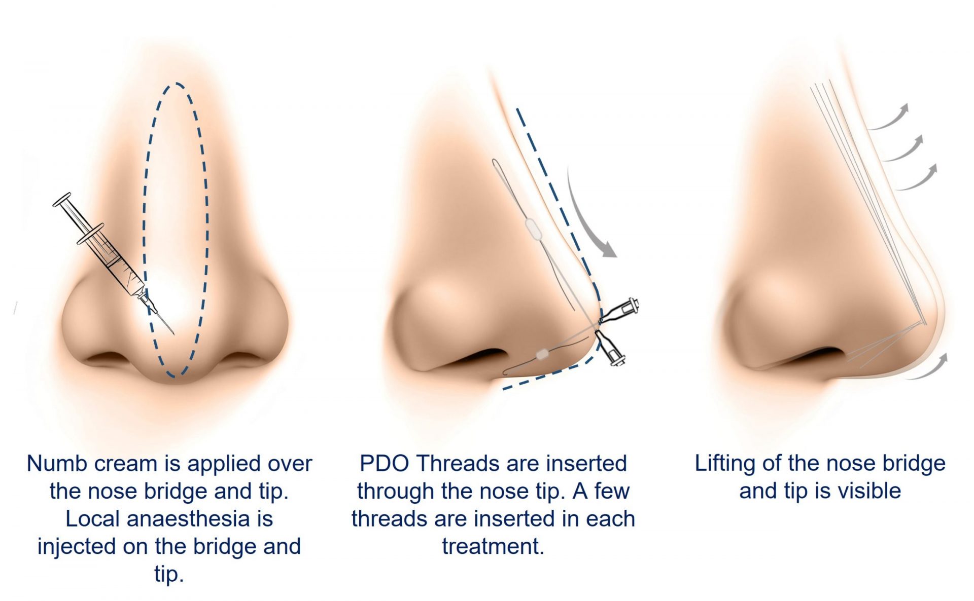 hiko nose thread lift process