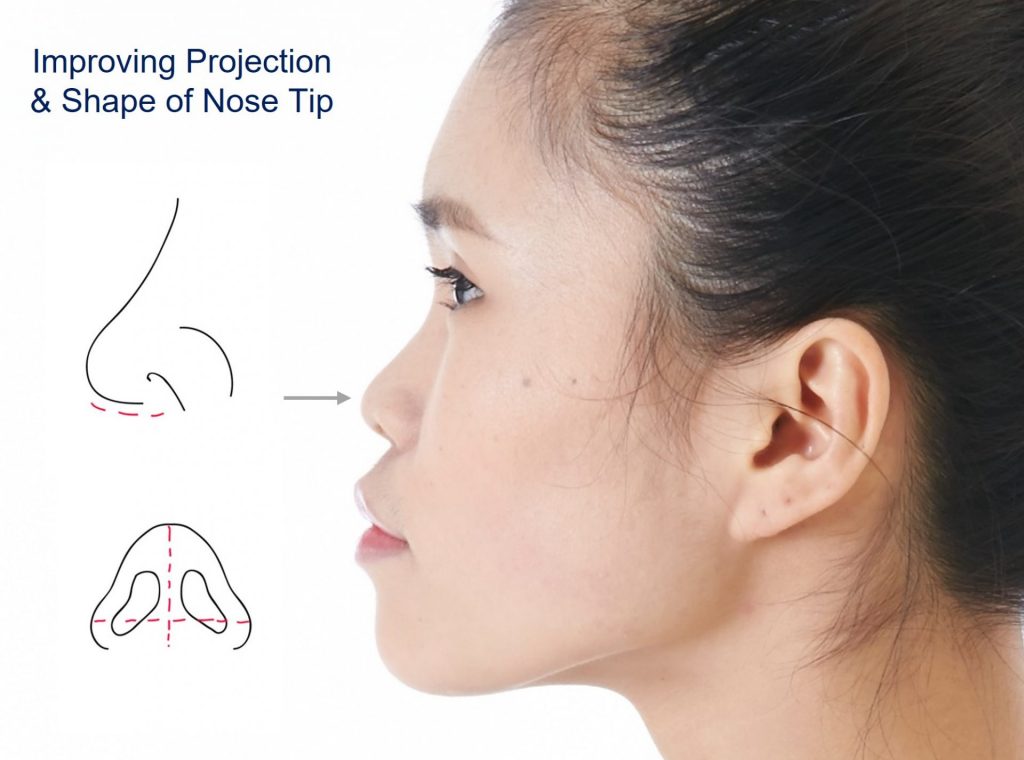 The Ultimate Guide To HIKO Korean Nose Thread Lift In Singapore | Dream ...