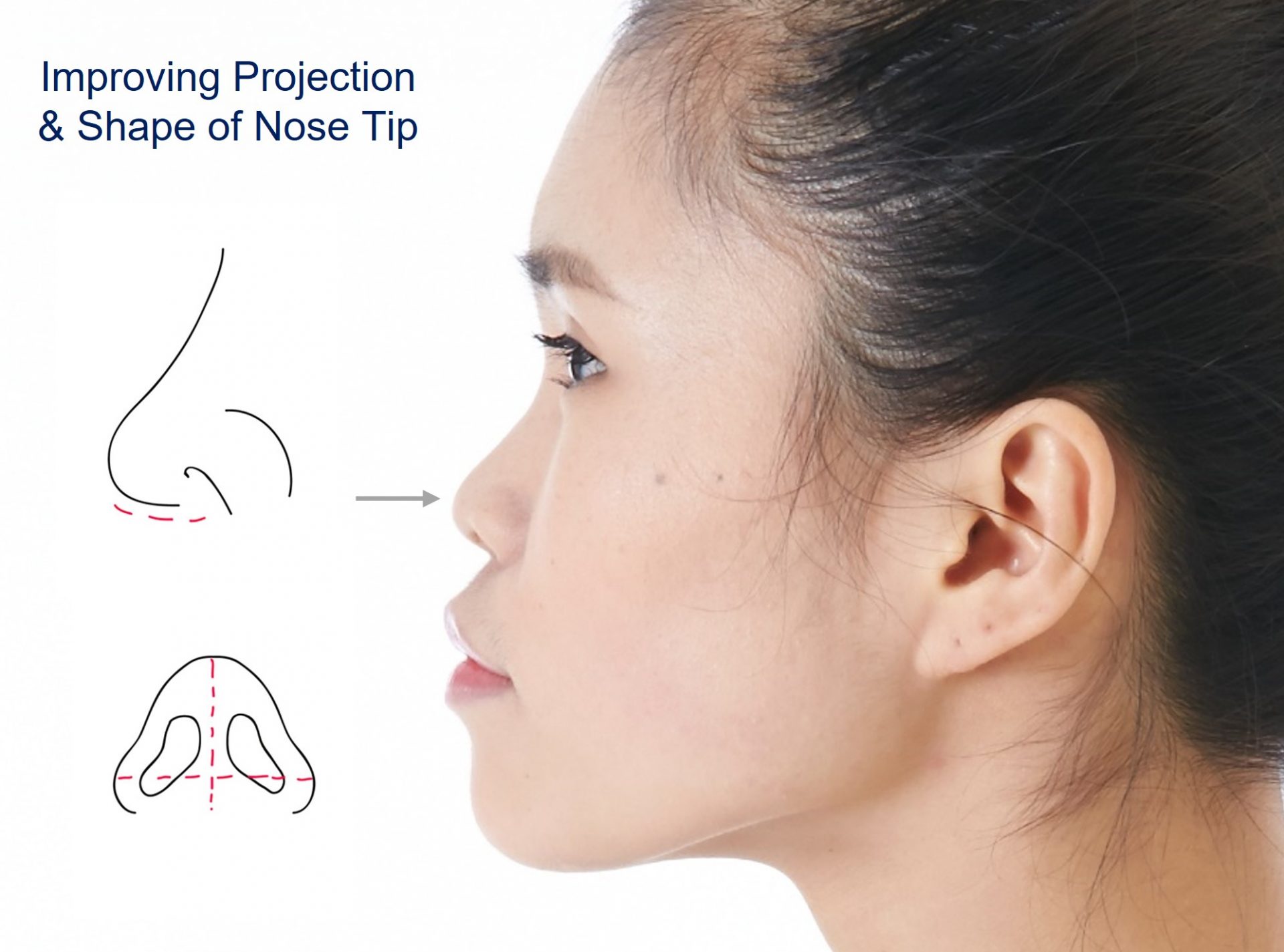 nose tip enhancement singapore