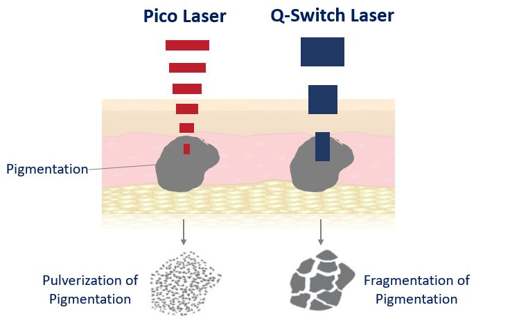 pico laser for pigmentation
