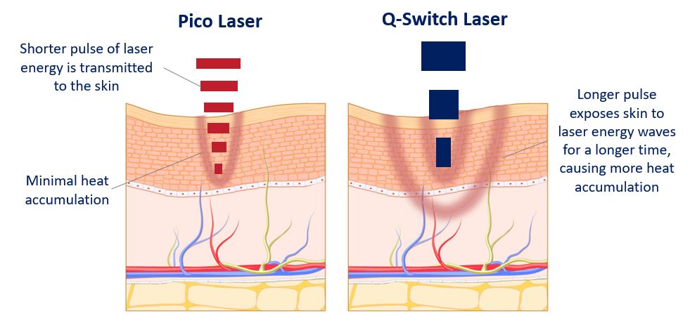 pico laser versus q-switch laser treatment