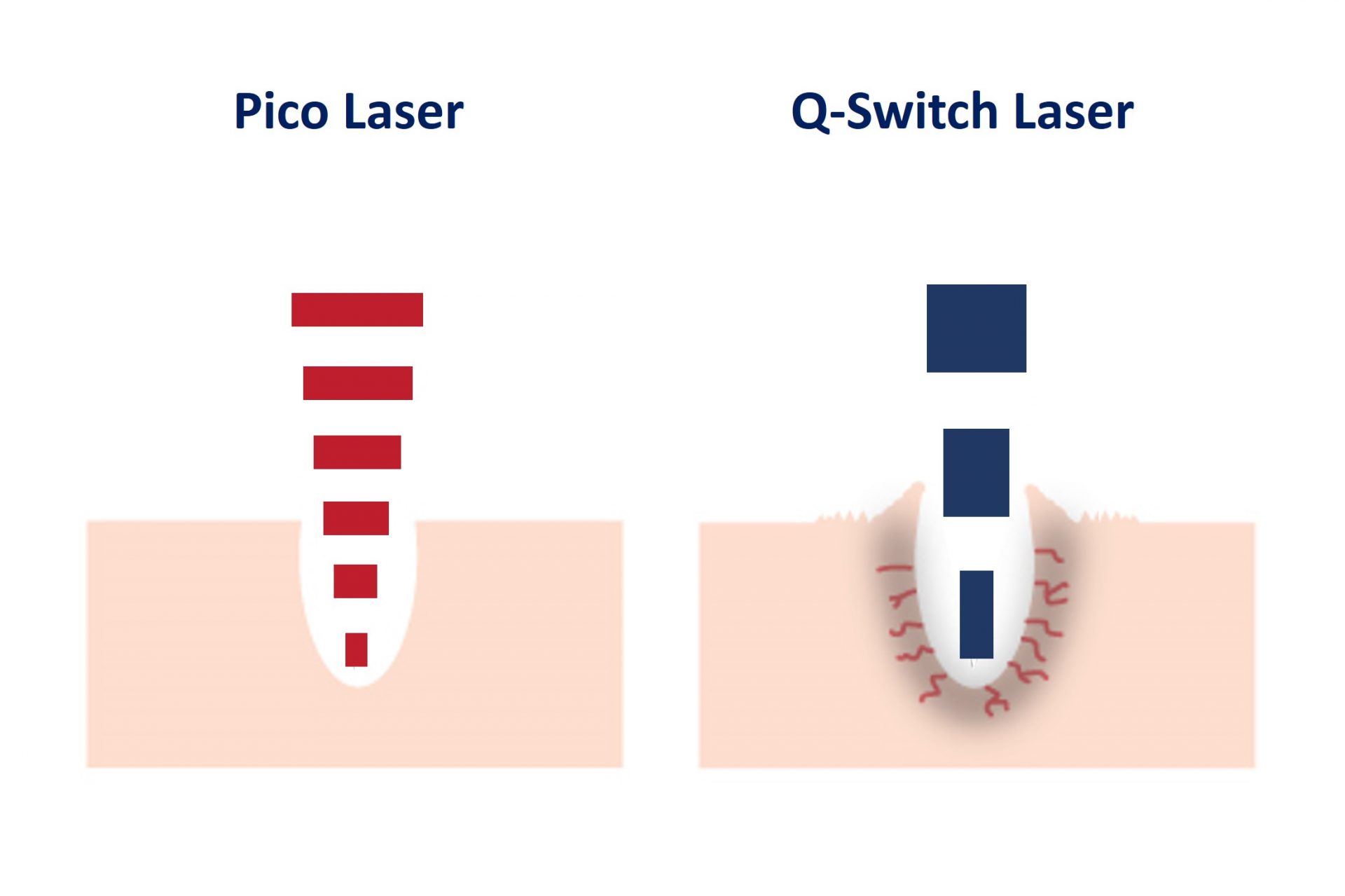 laser beam comparison