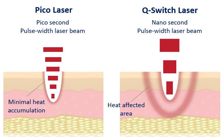 pico laser versus q-switch laser