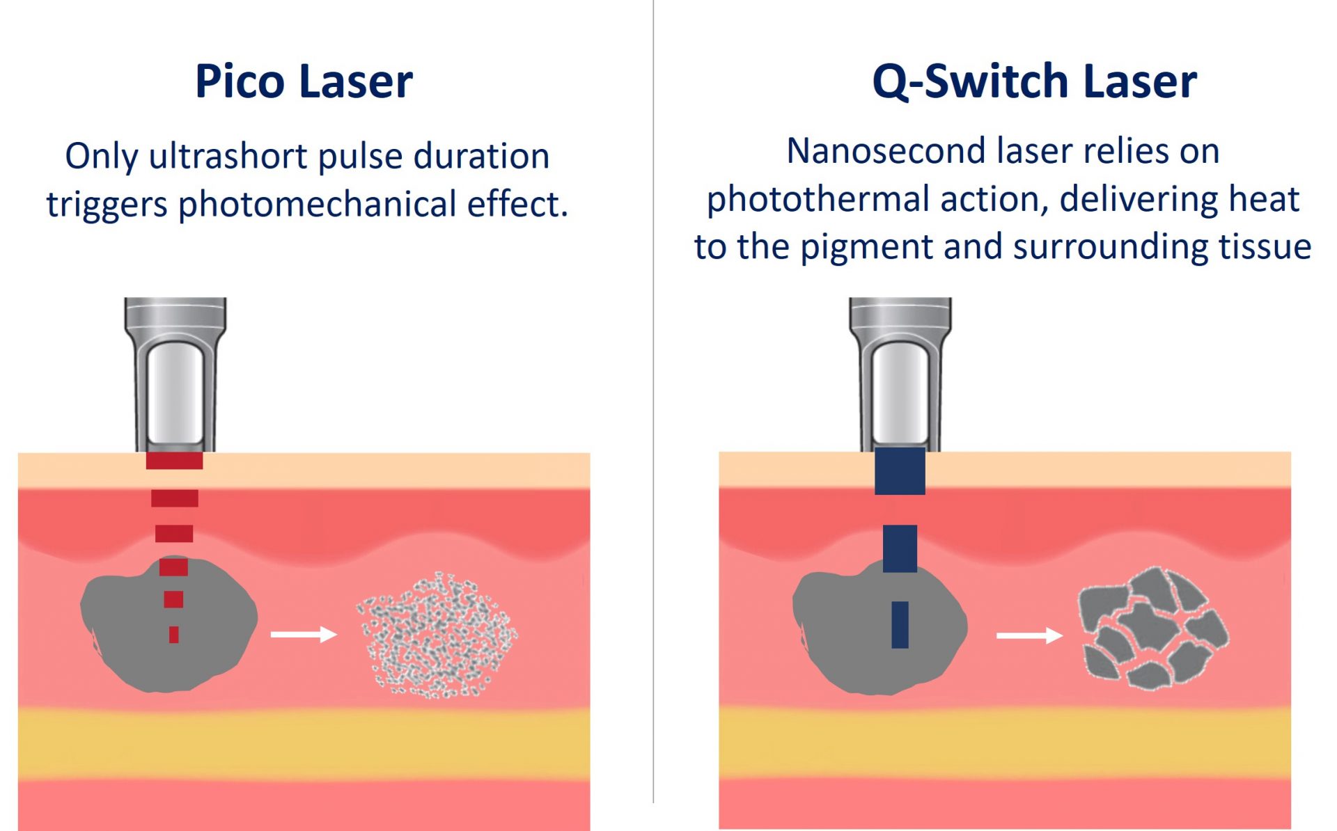 how pico laser lighten pigmentation