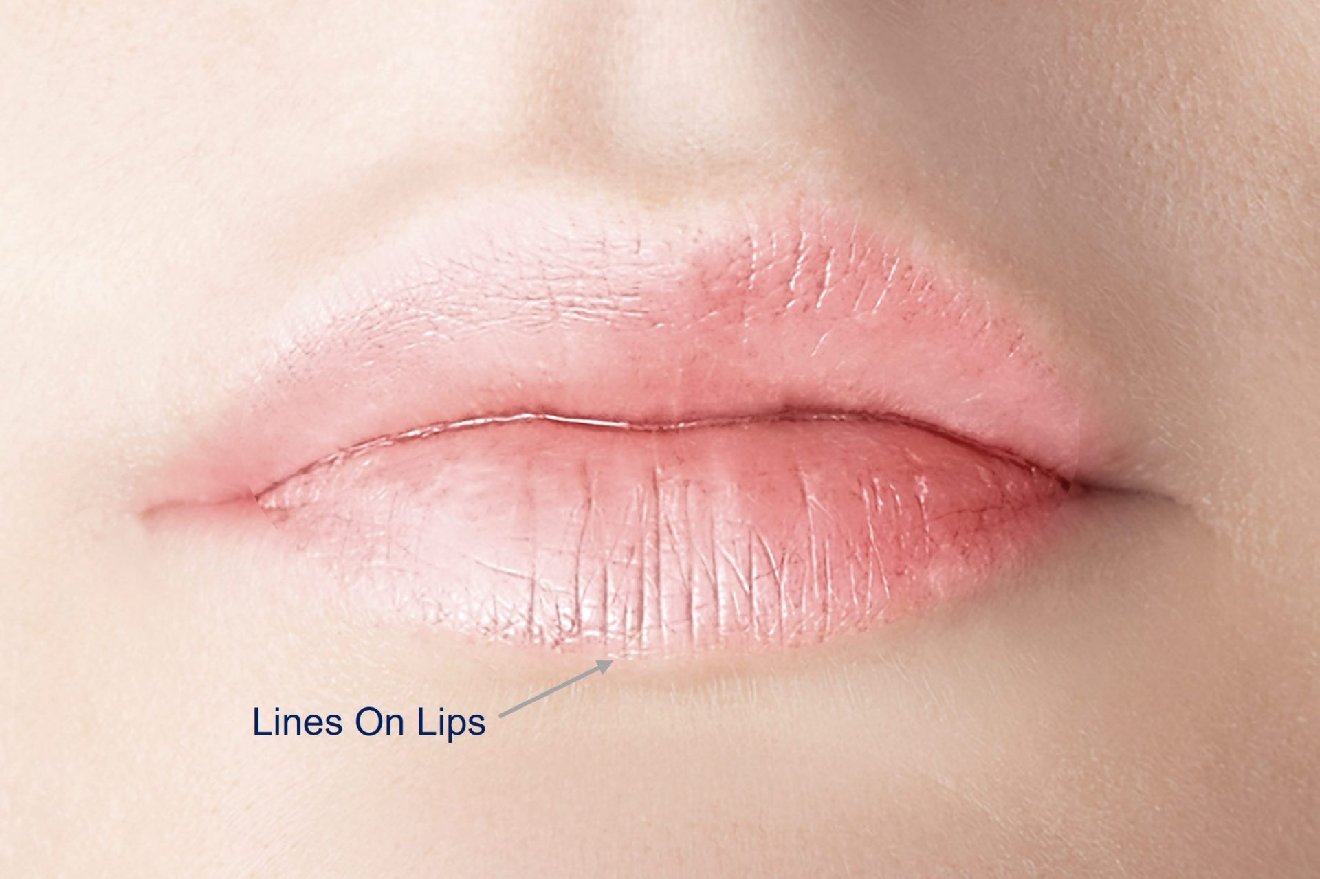 plump lip lines and wrinkles