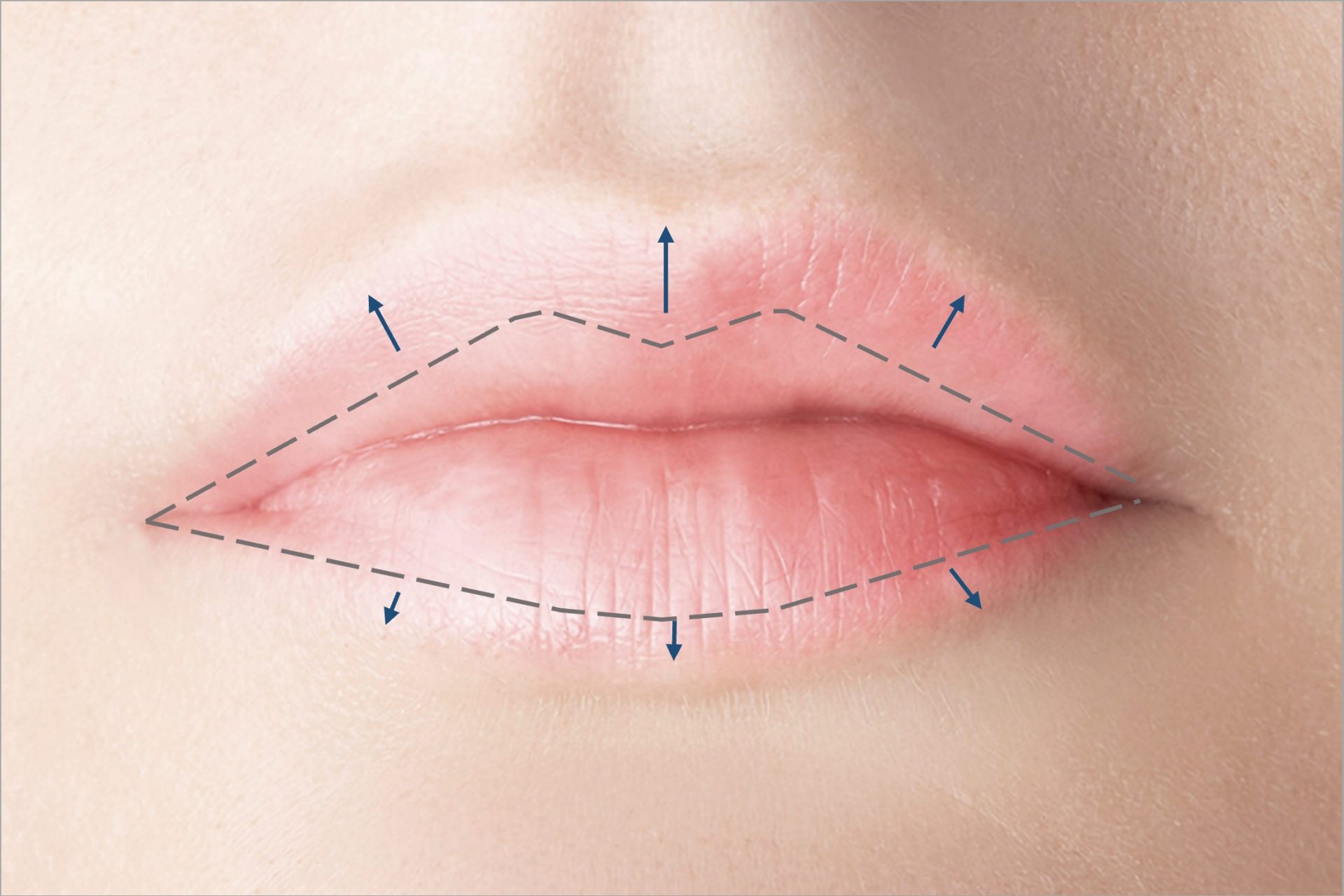 plumper and bigger lips with fillers
