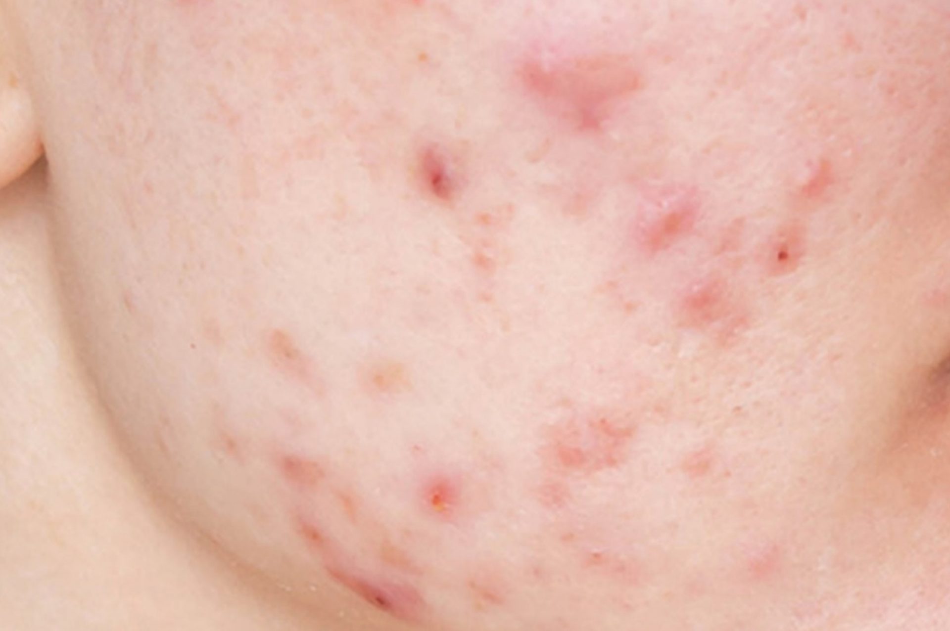 raised acne scar