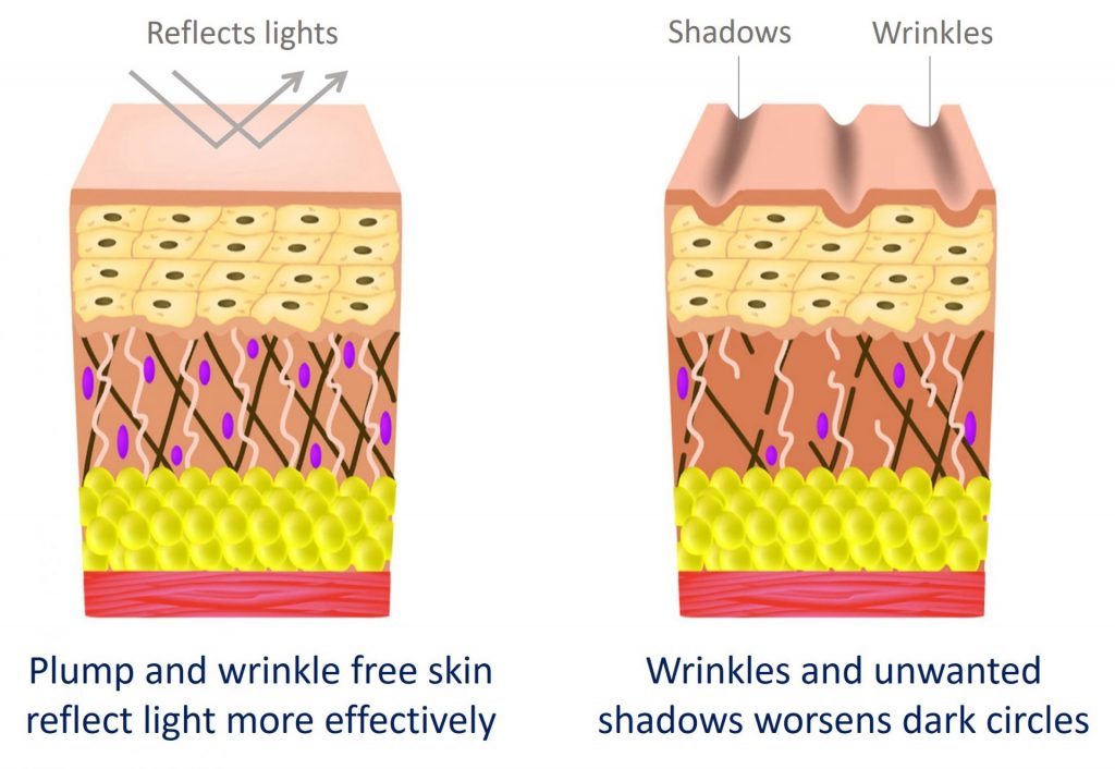 Dermal Filler Injection For Under Eye Dark Circles – How It Works ...