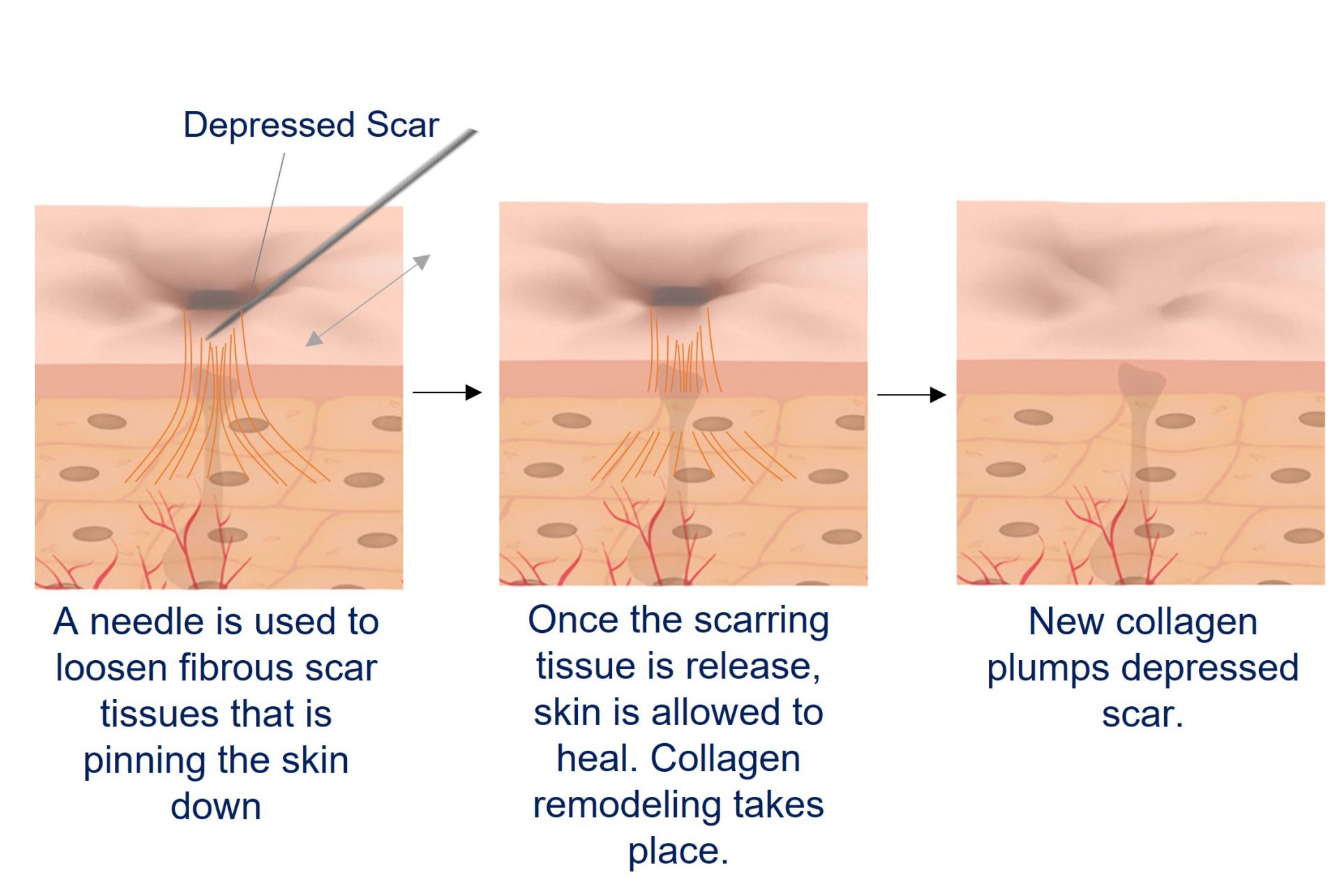 subcision for acne scar