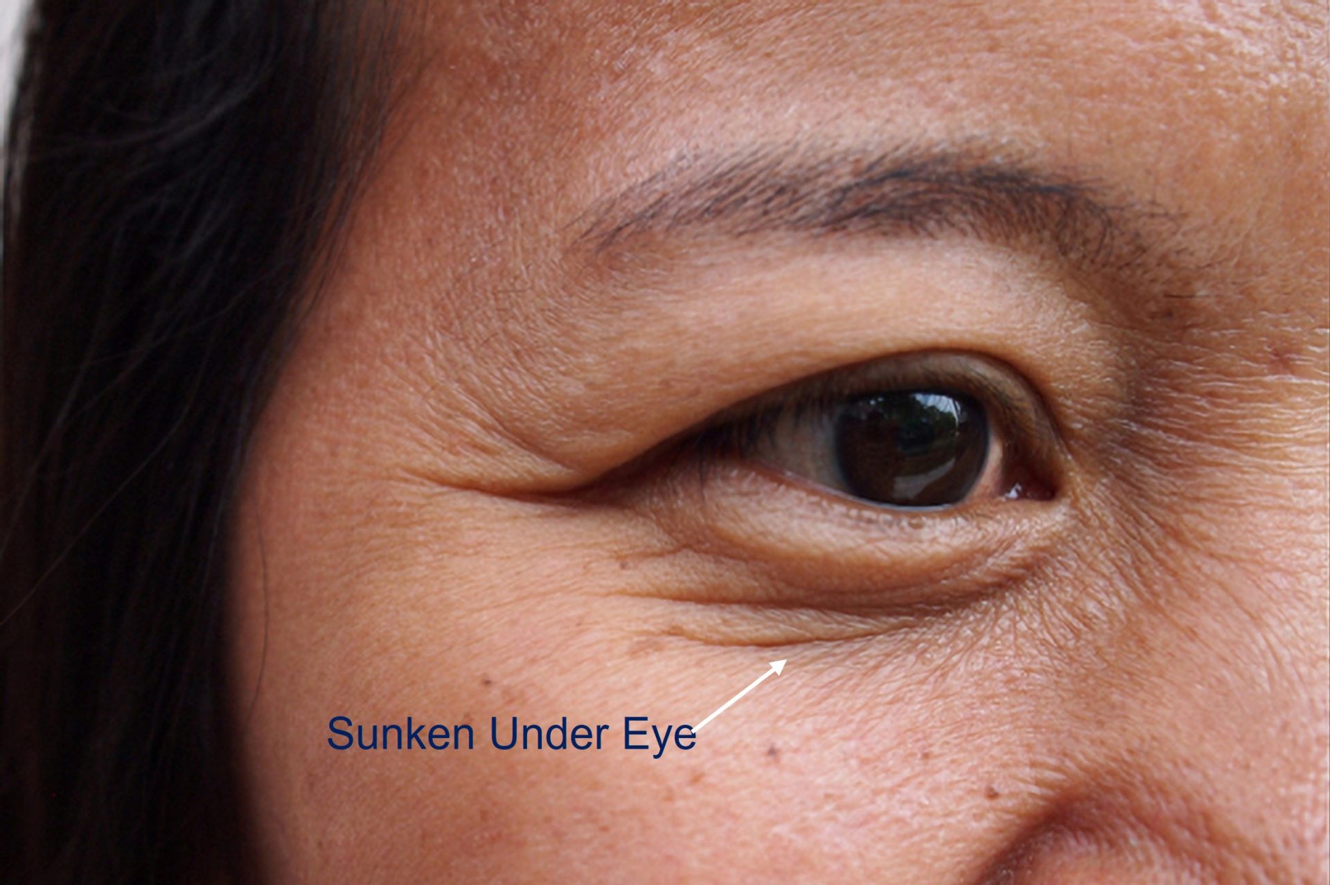 sunken under eye