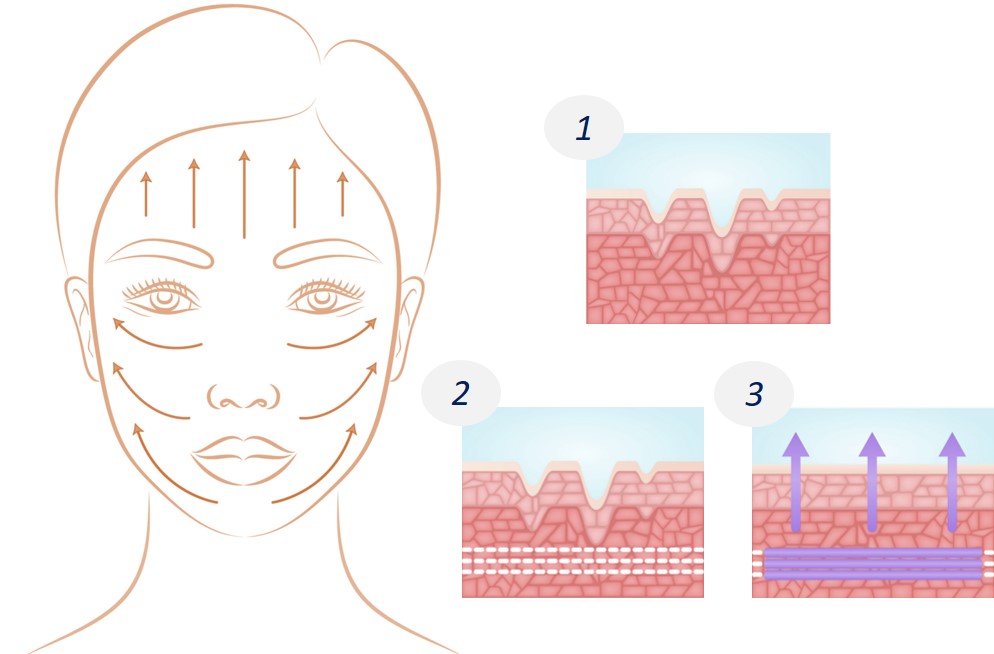 threadlift for v-li