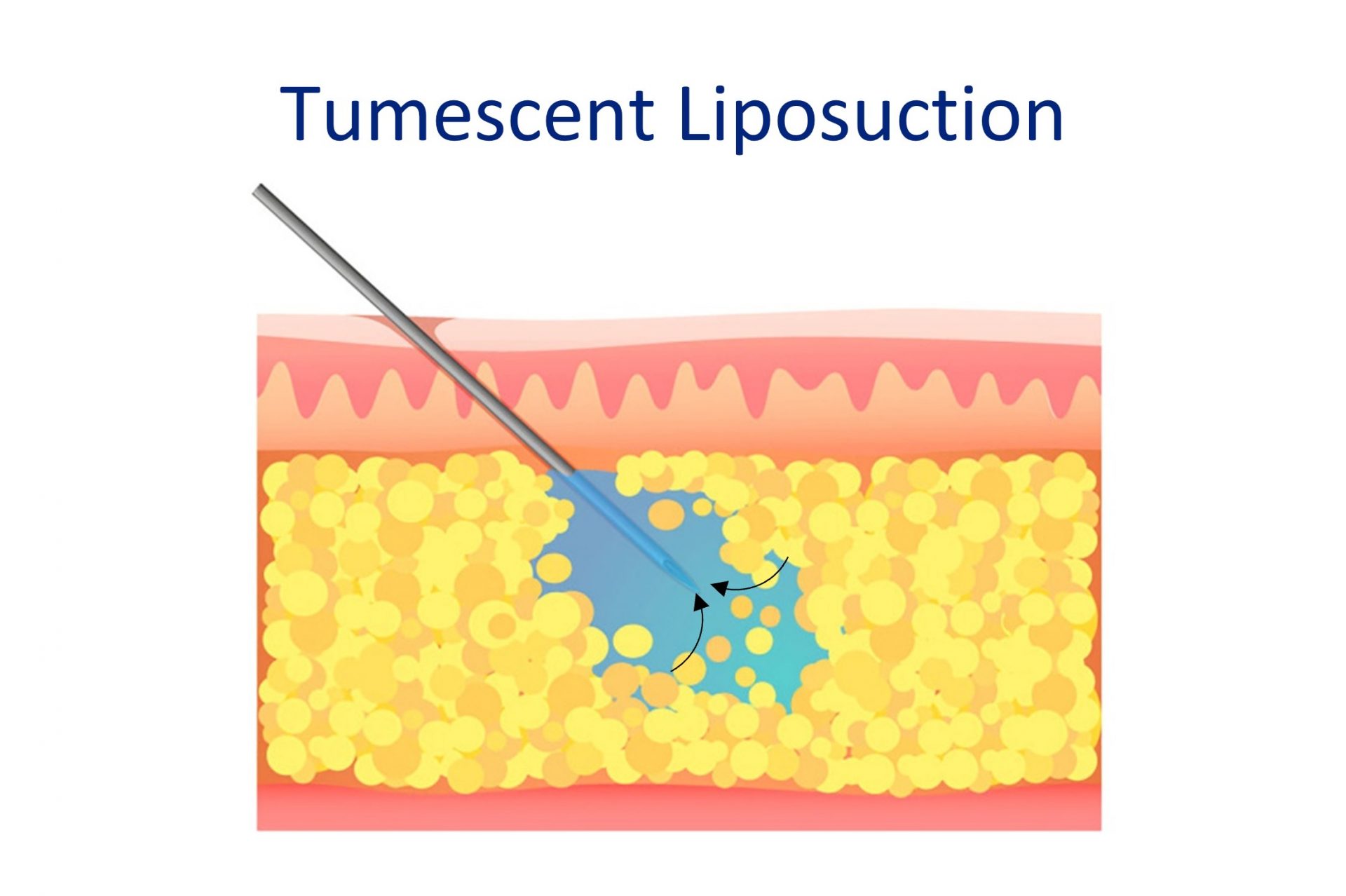 tumescent liposuction