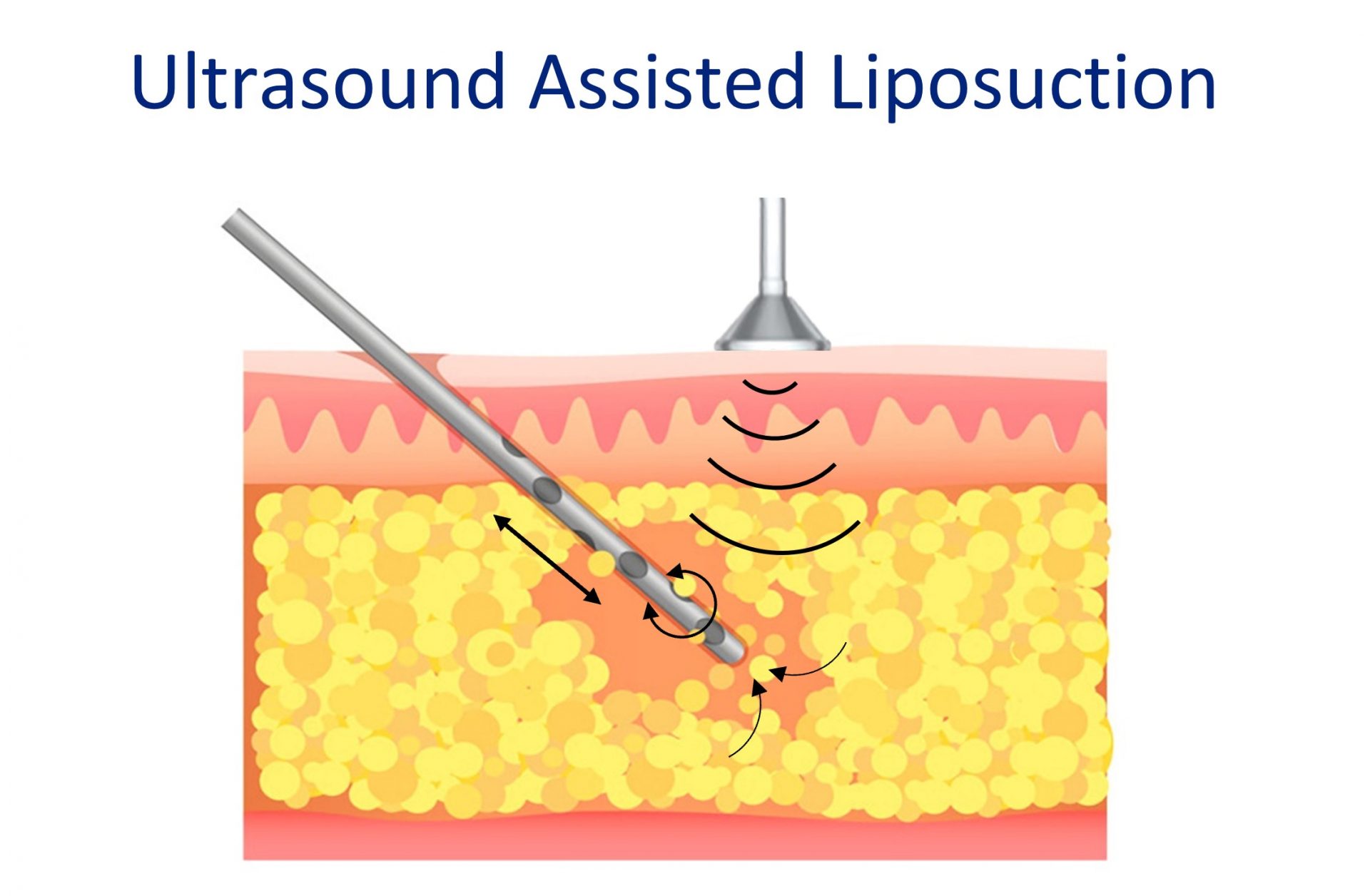 ultrasound assisted liposuction