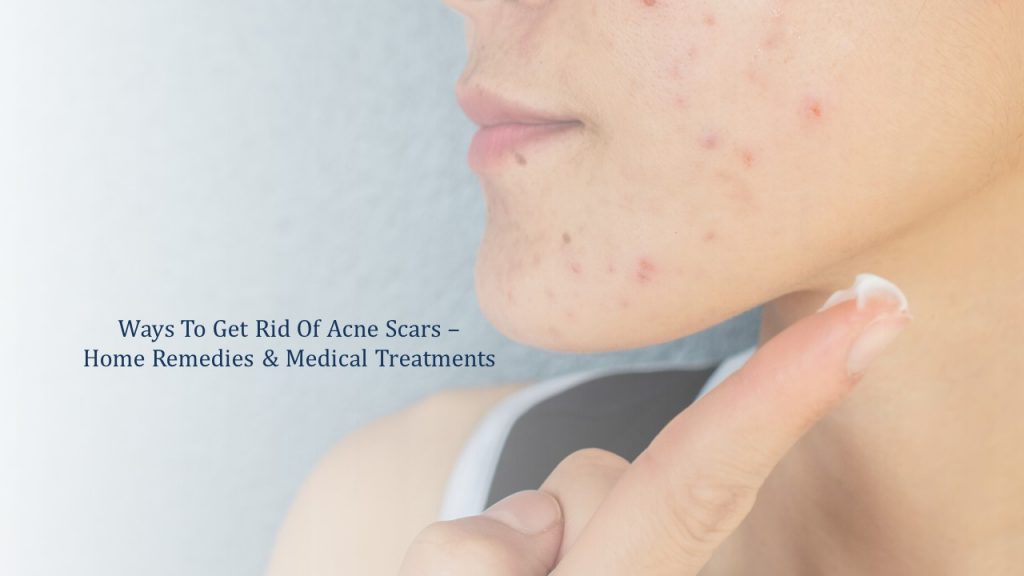 ways to get rid of acne scars - home remedies and medical treatments