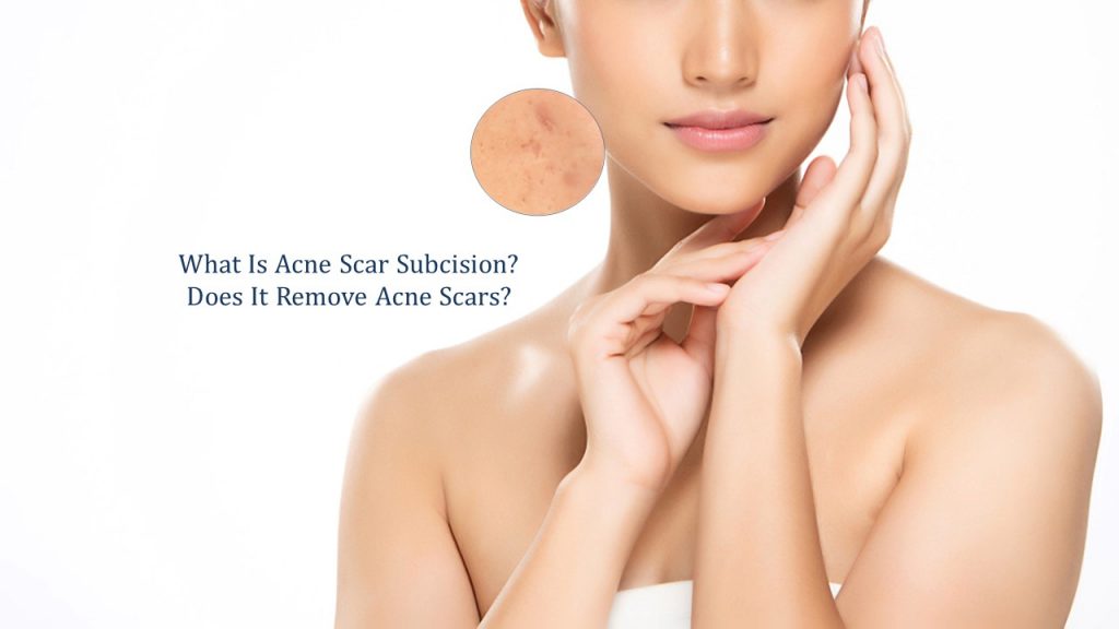 what is acne scar subcision