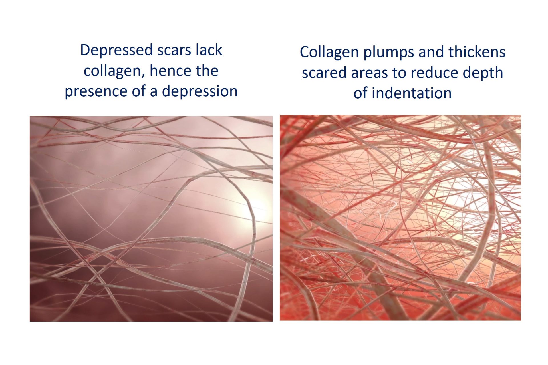 collagen regeneration with sylfirm x treatment