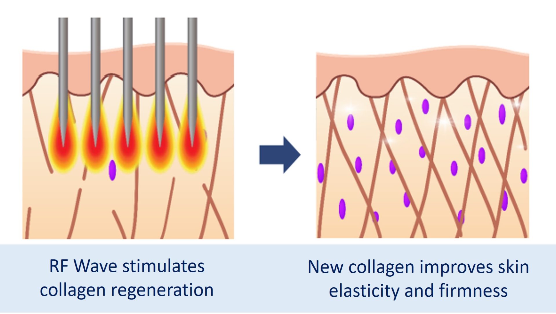 collagen renewal after sylfirm x treatment