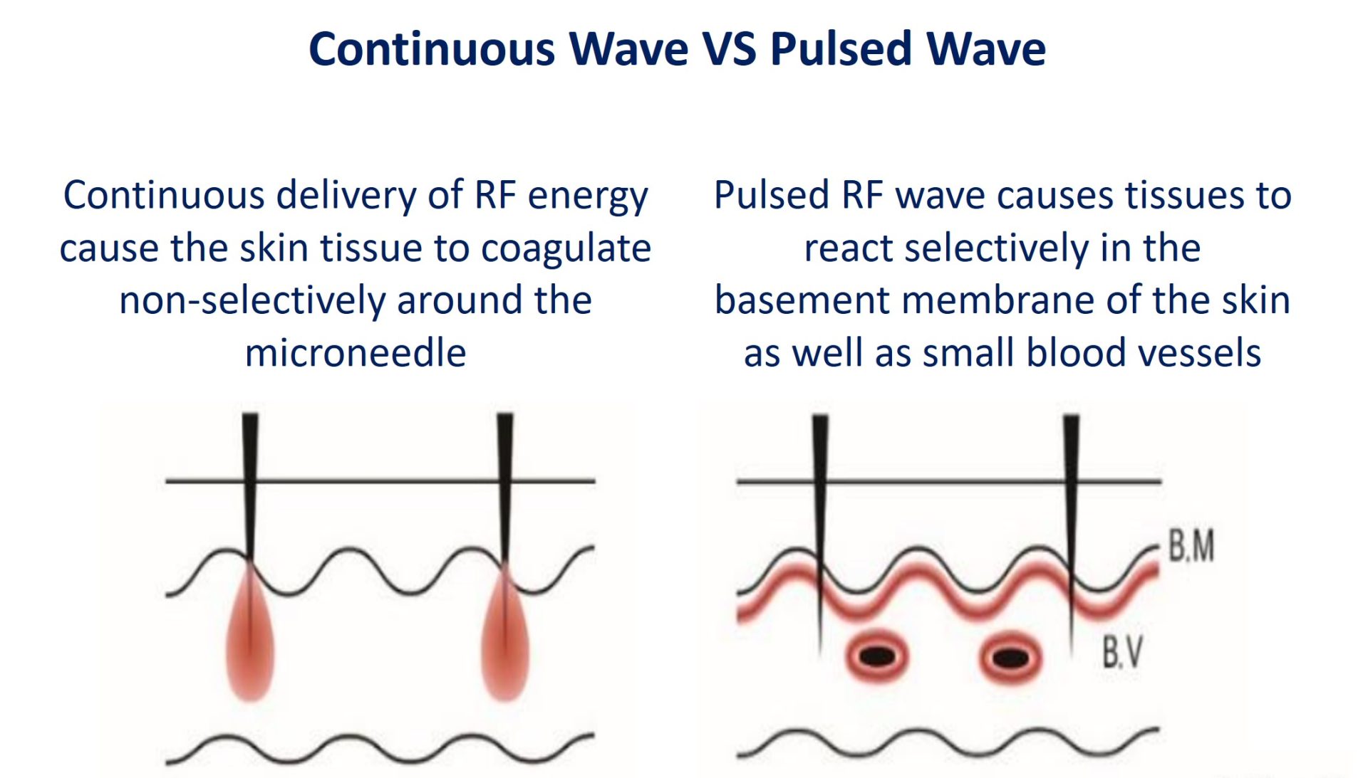 continuous vs pulsed rf wave