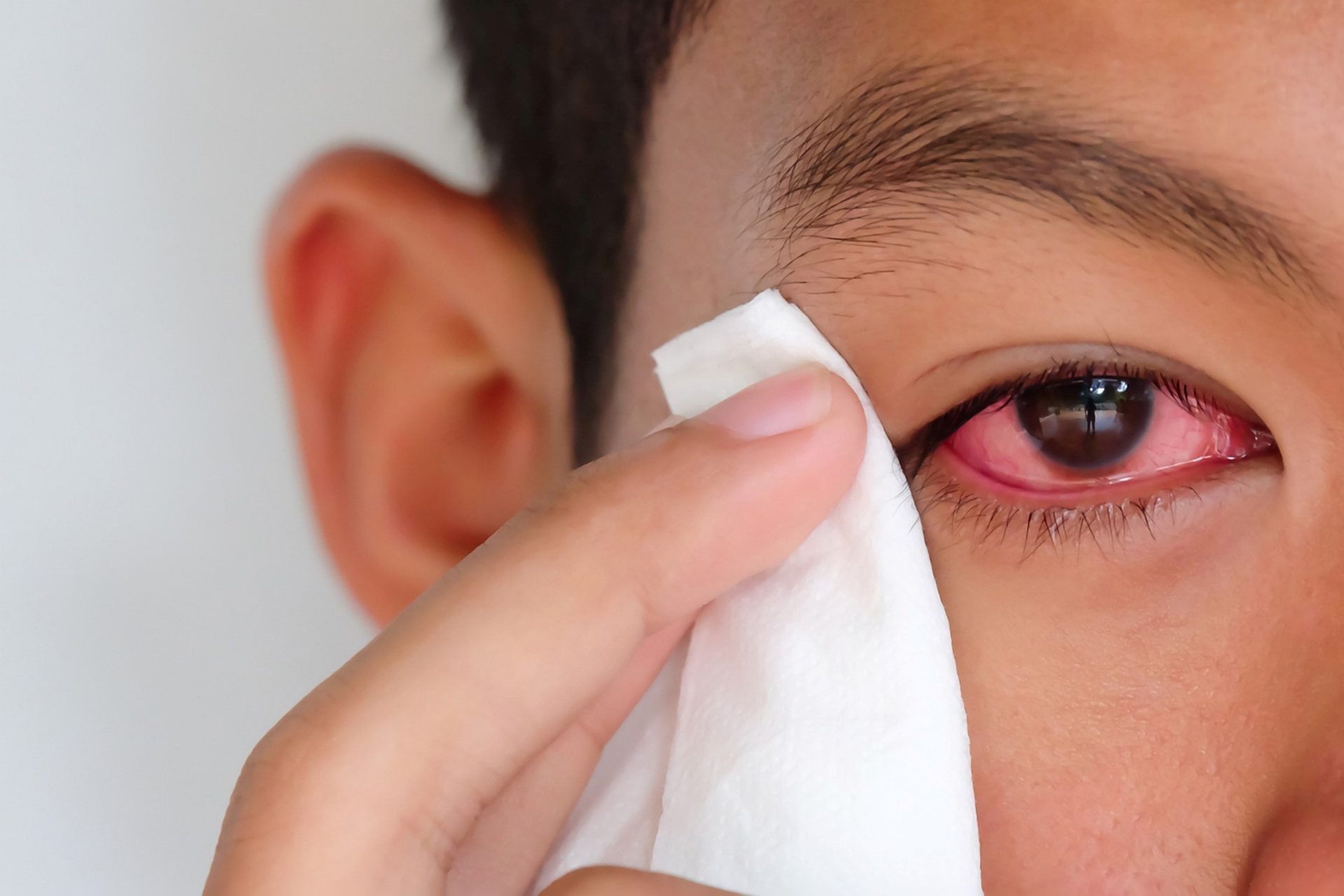 eye irritation due to droopy eyelids