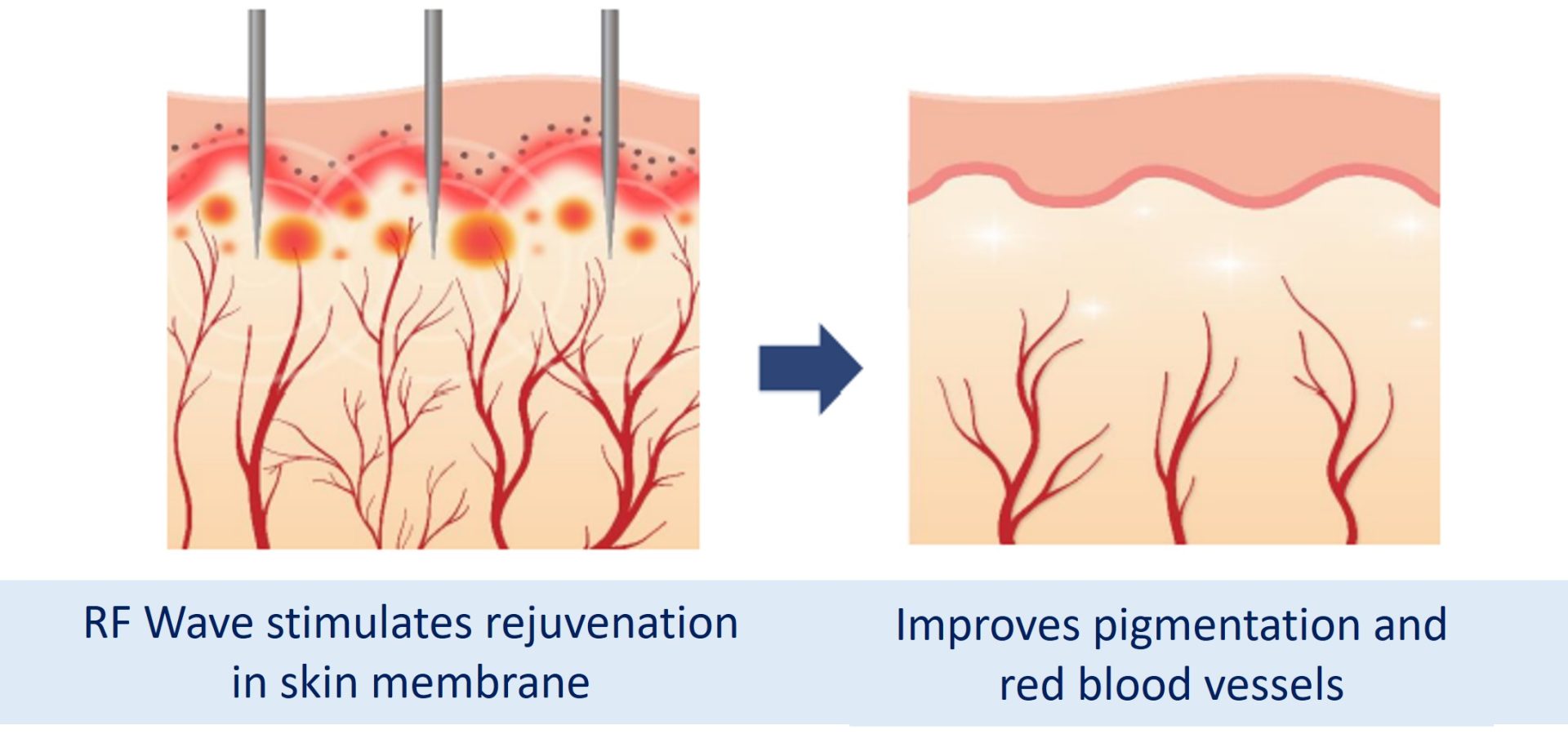 pigment and blood vessel reduction with sylfirm x
