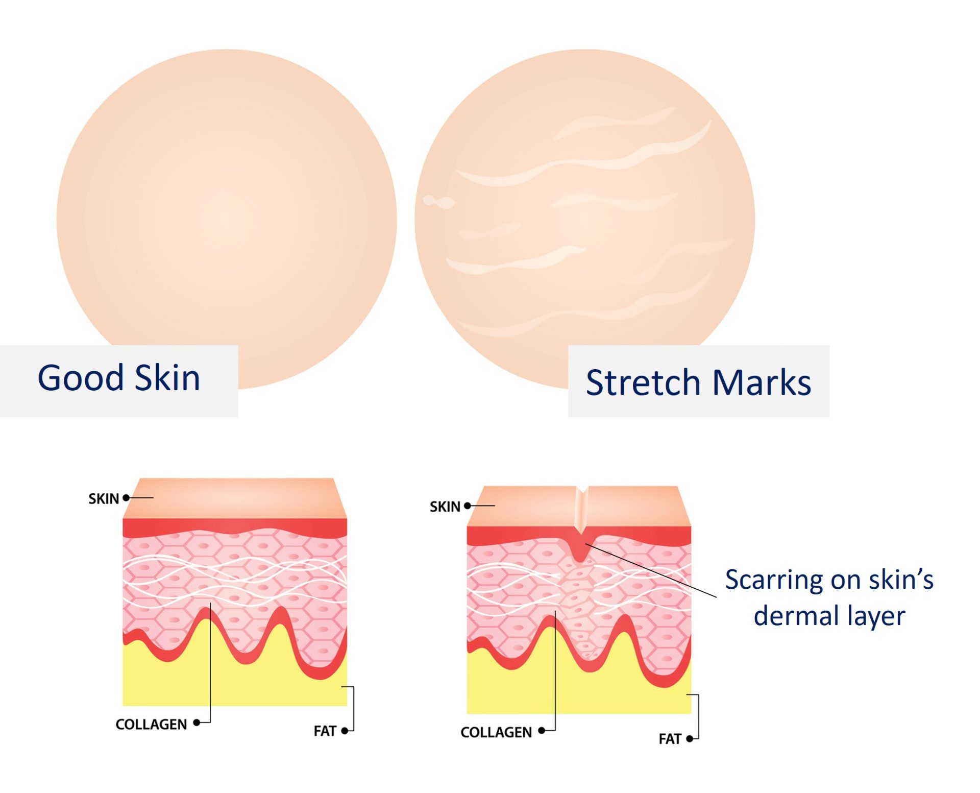 formation of stretch marks