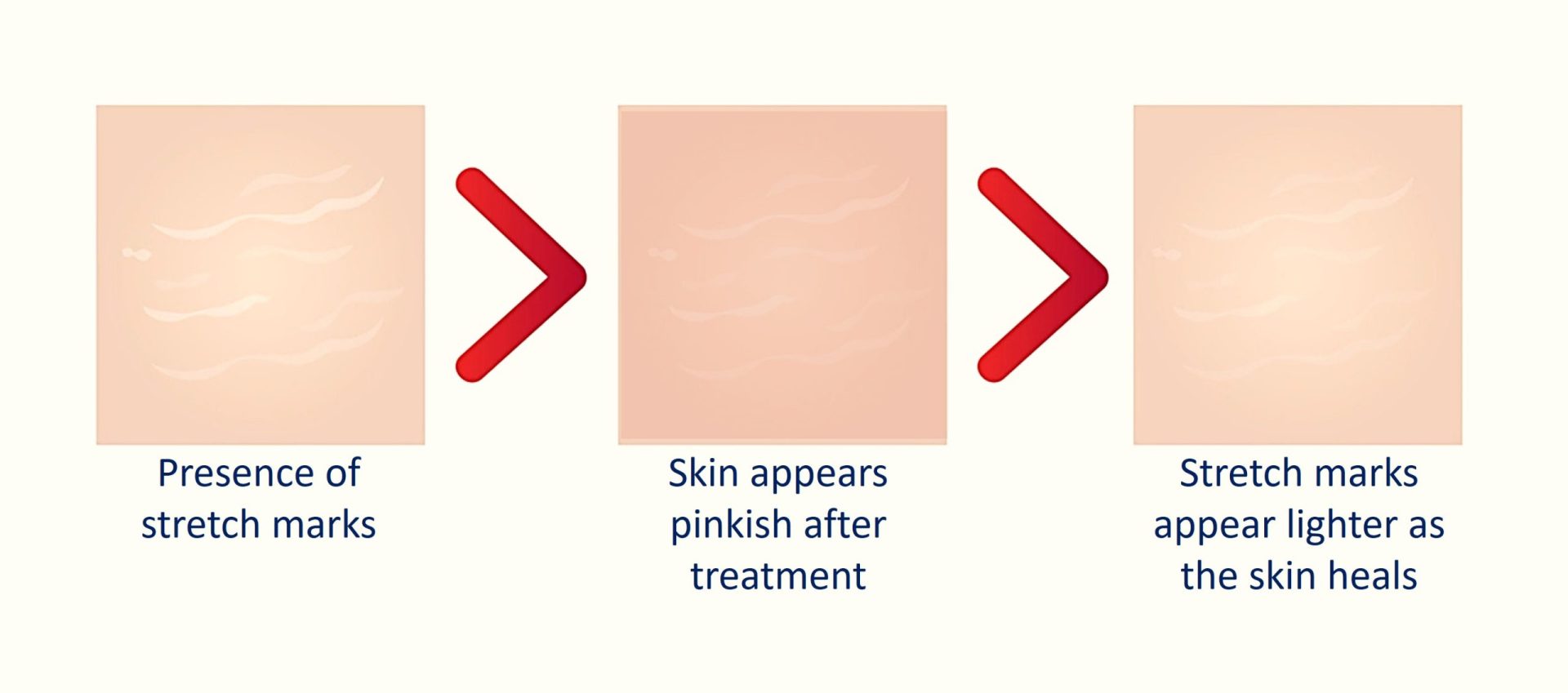 lightening stretch marks with sylfirm x treatment