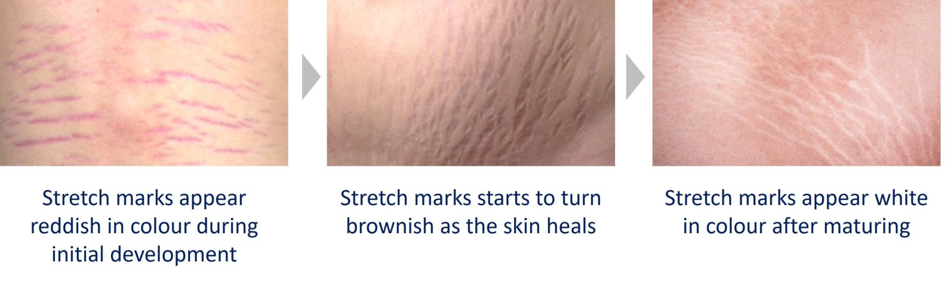 maturity of stretch marks