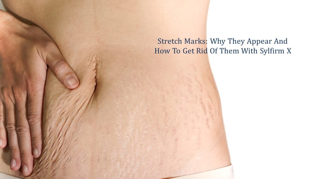 stretch marks - why they appear and how to get rid of them