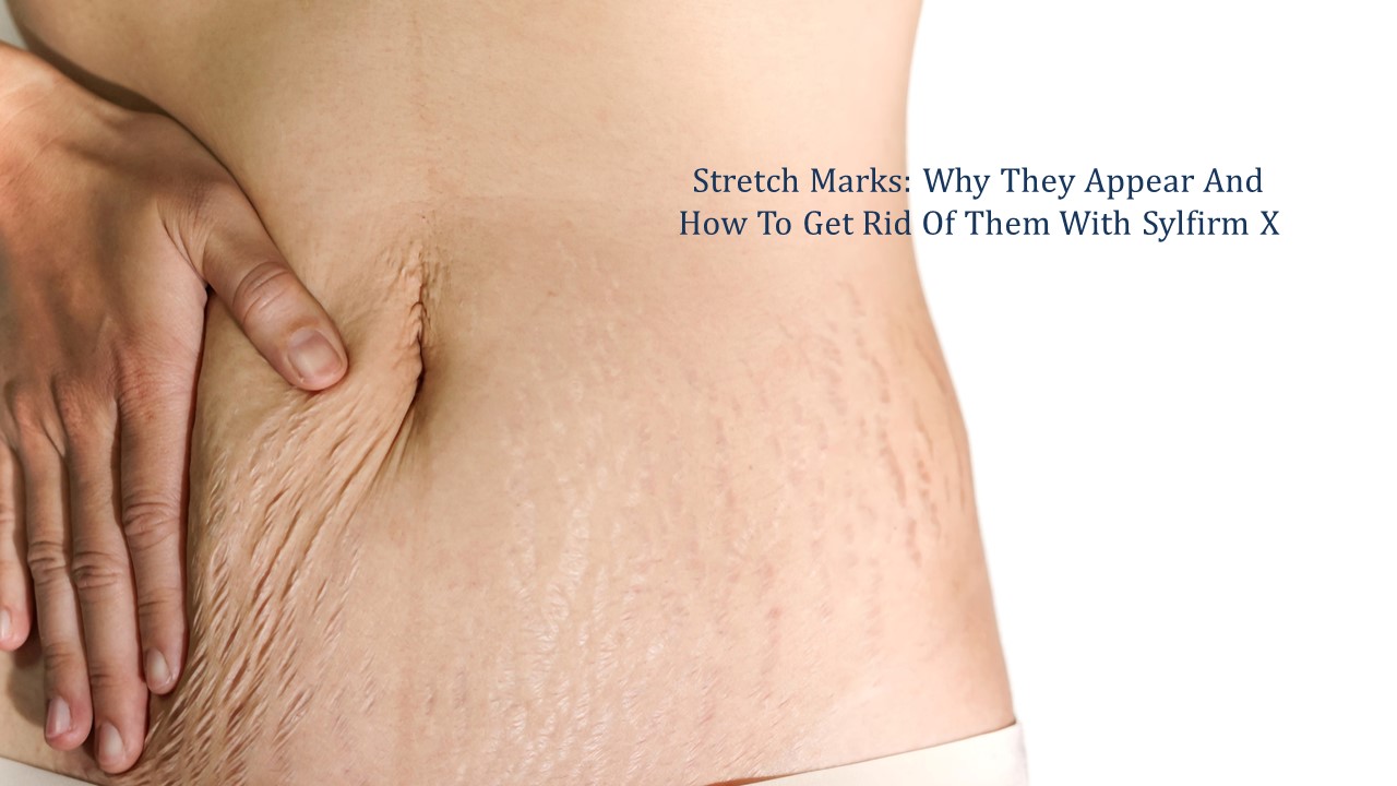 How to Deal with Stretch Marks