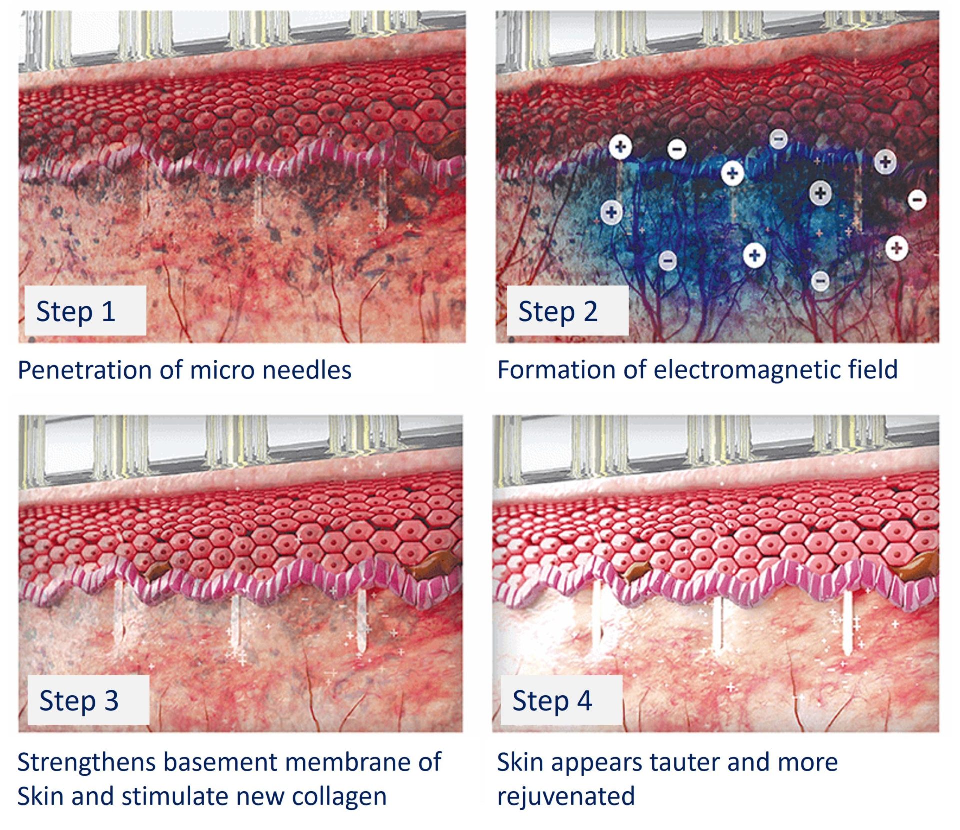 skin rejuvenation with sylfirm x