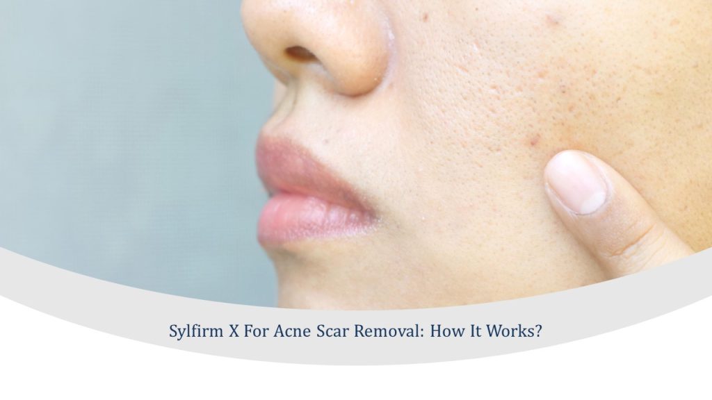 sylfirm x for acne scar removal treatment in singapore