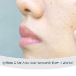 sylfirm x for acne scar removal treatment in singapore