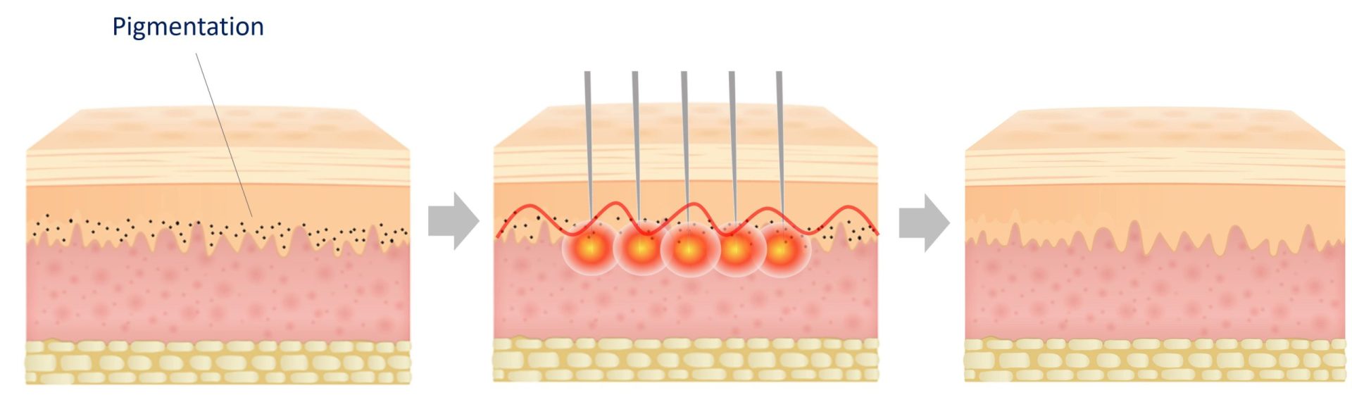 pigmentation treatment with sylfirm x