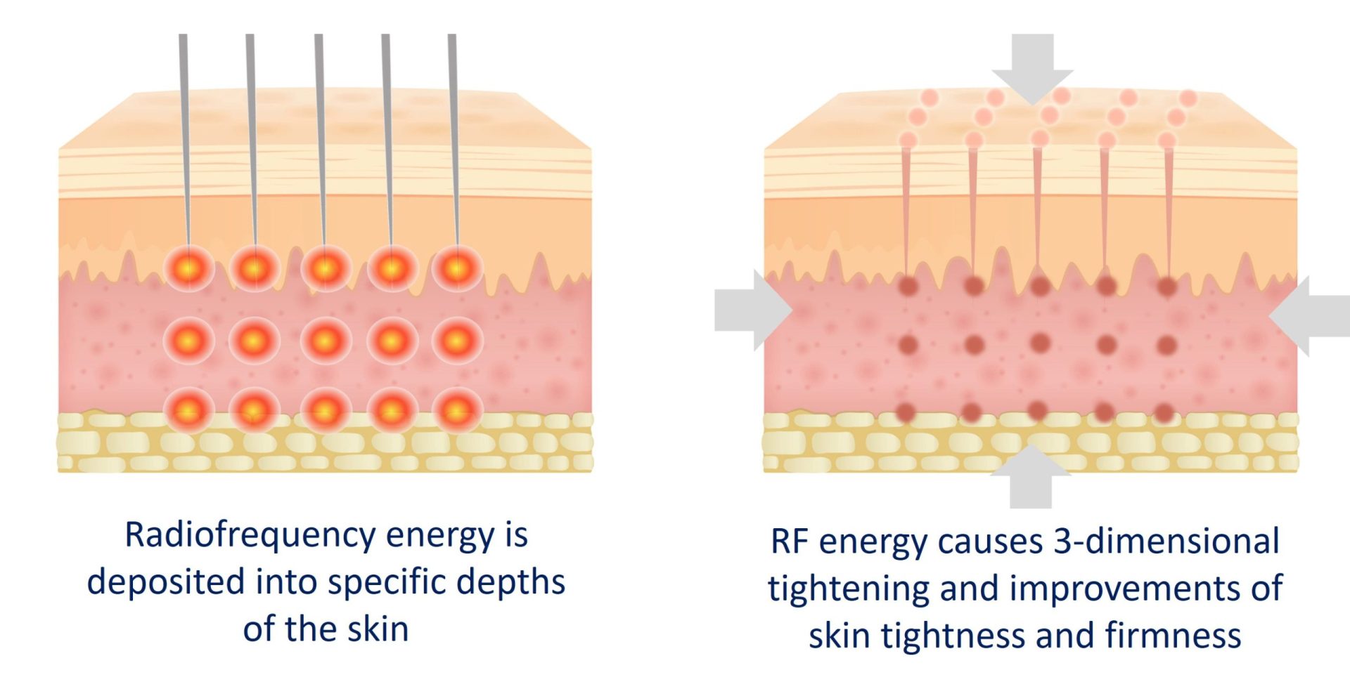 skin rejuvenation with sylfirm x