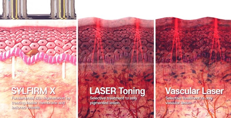 sylfirm x vs laser treatment