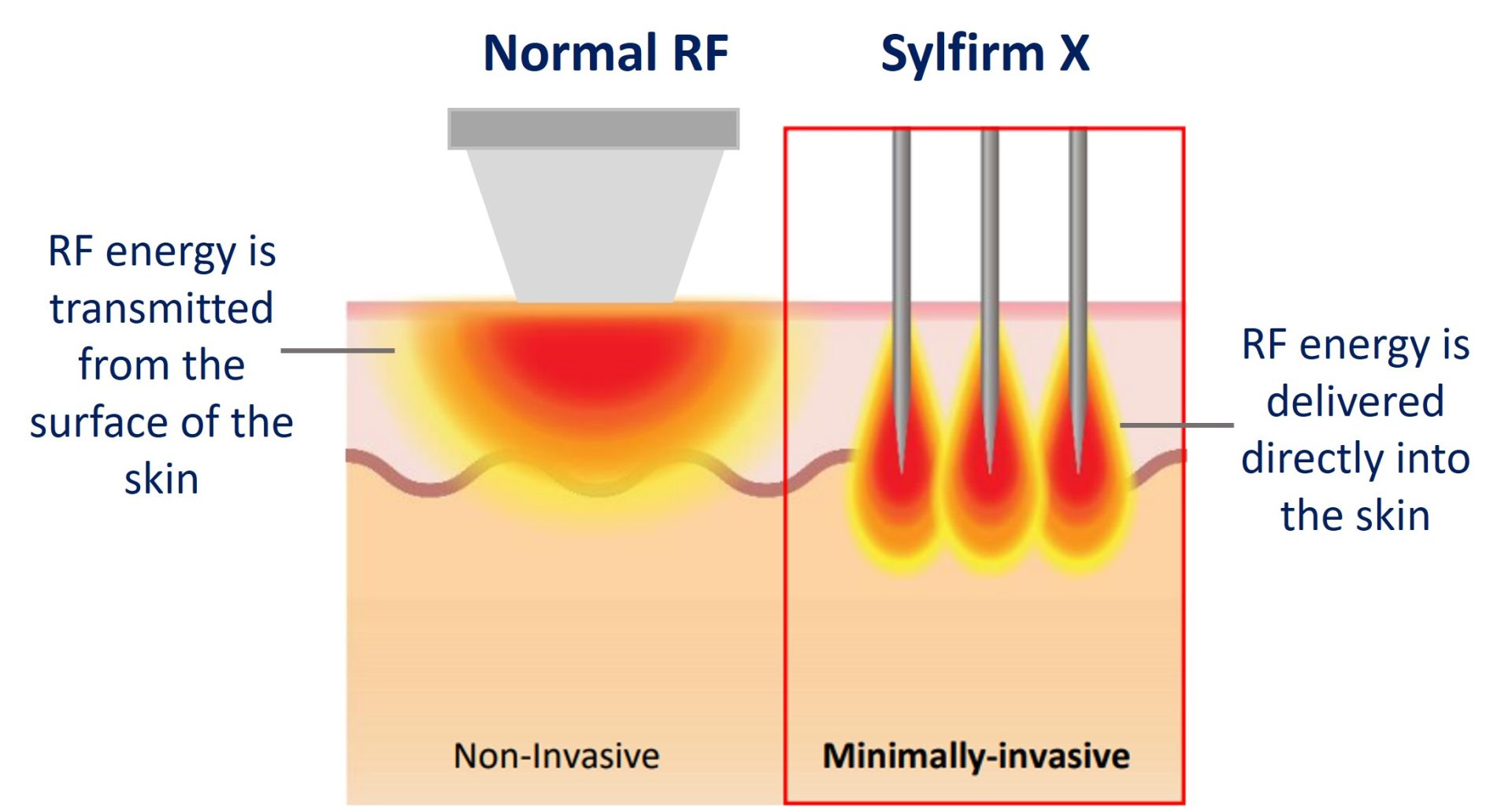 sylfirm x rf vs normal rf treatment