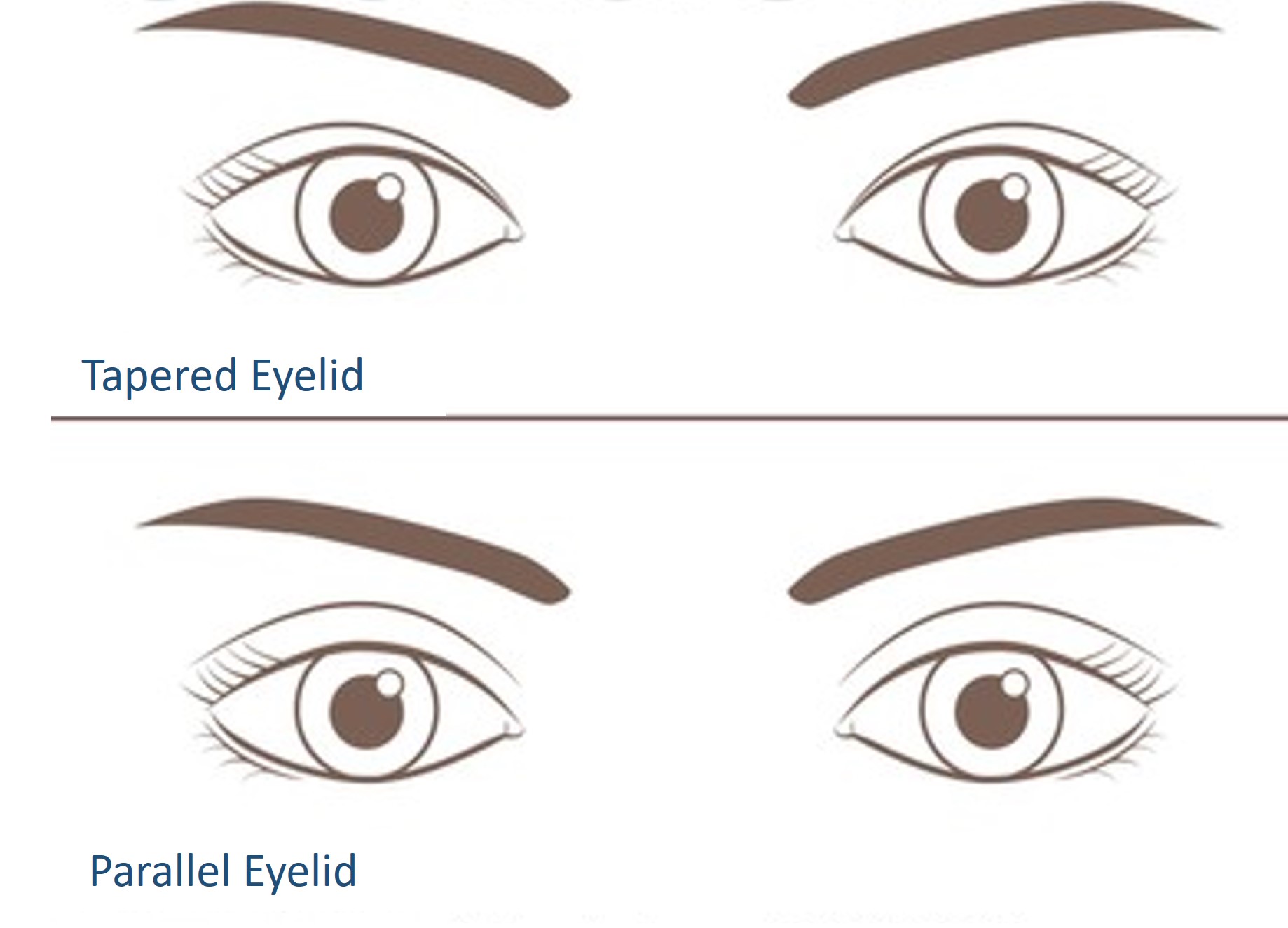 types of eyelid crease