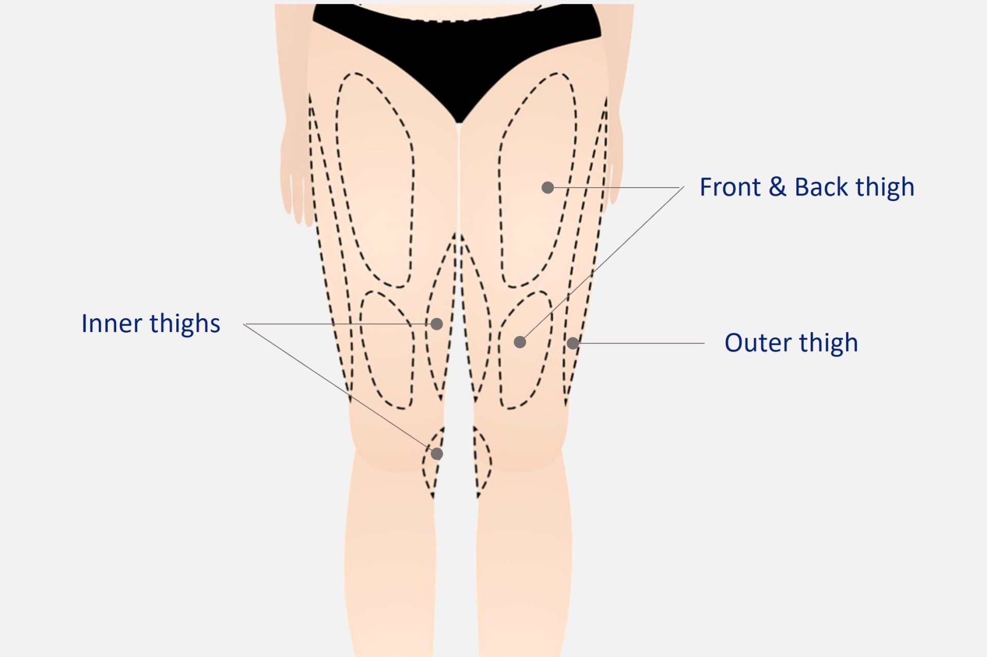 thigh liposuction procedure