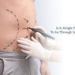 liposuction for men