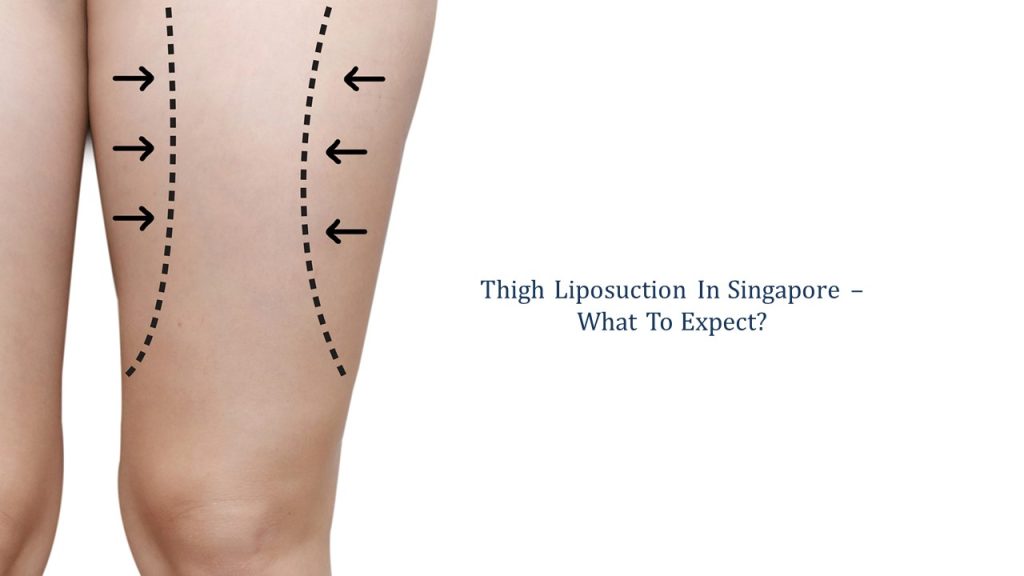 thigh liposuction in singapore