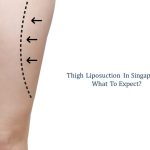 thigh liposuction in singapore