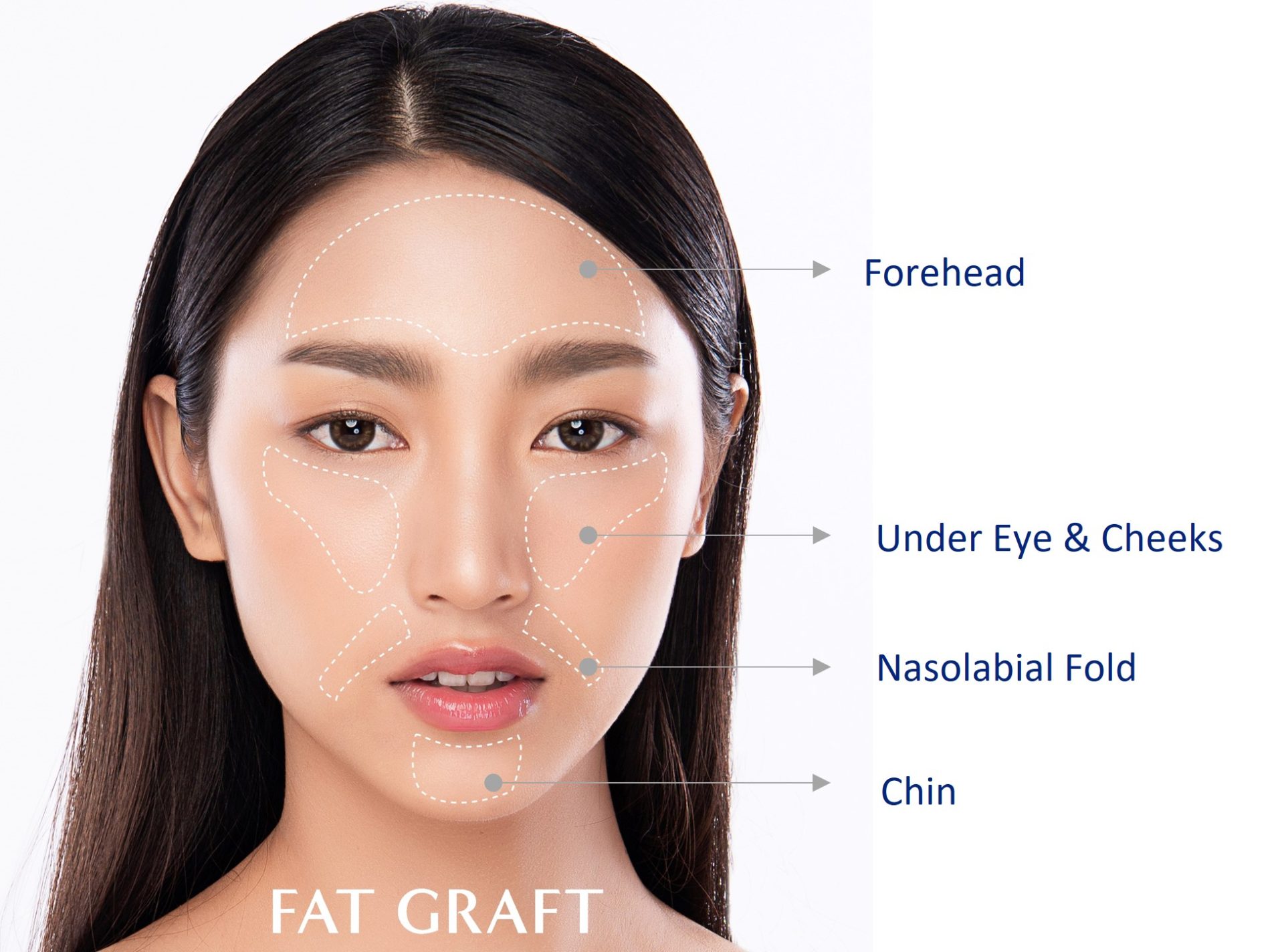 areas suitable for fat grafting