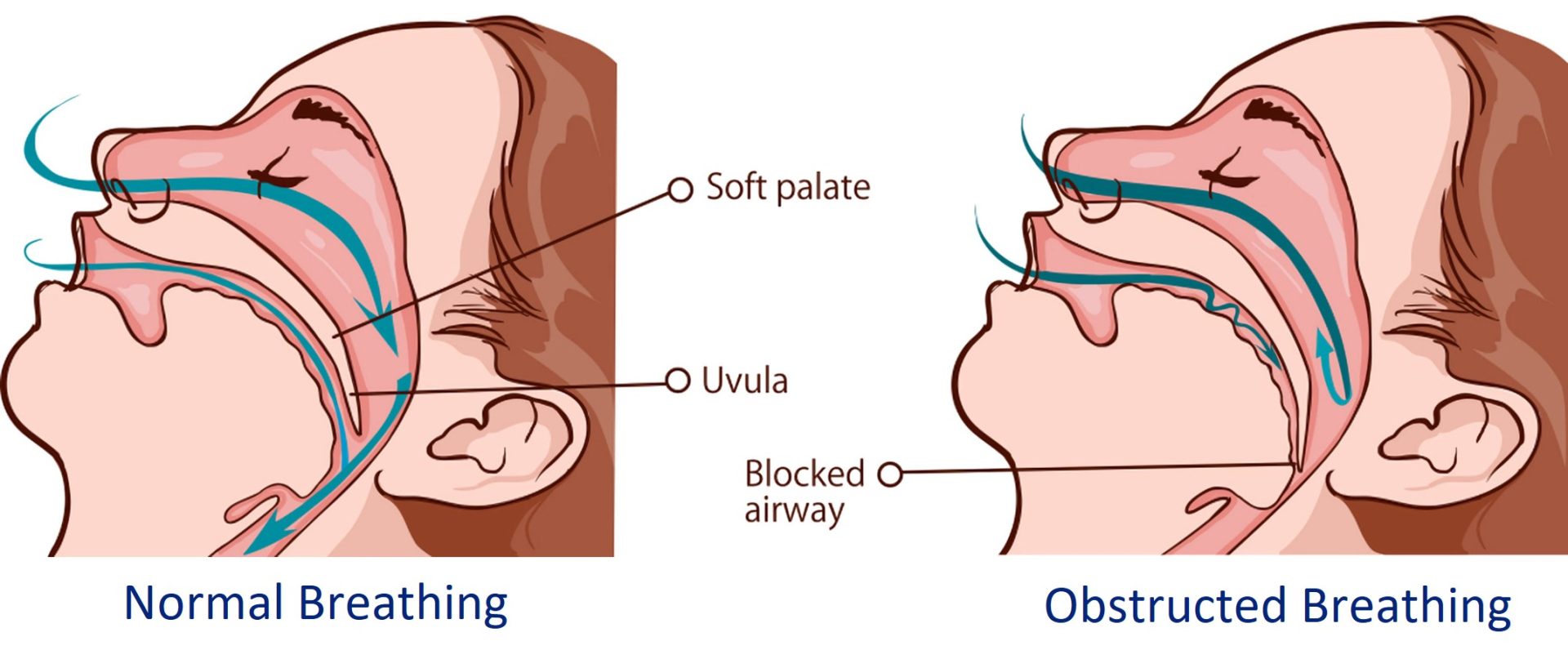 breathing issues that require rhinoplasty